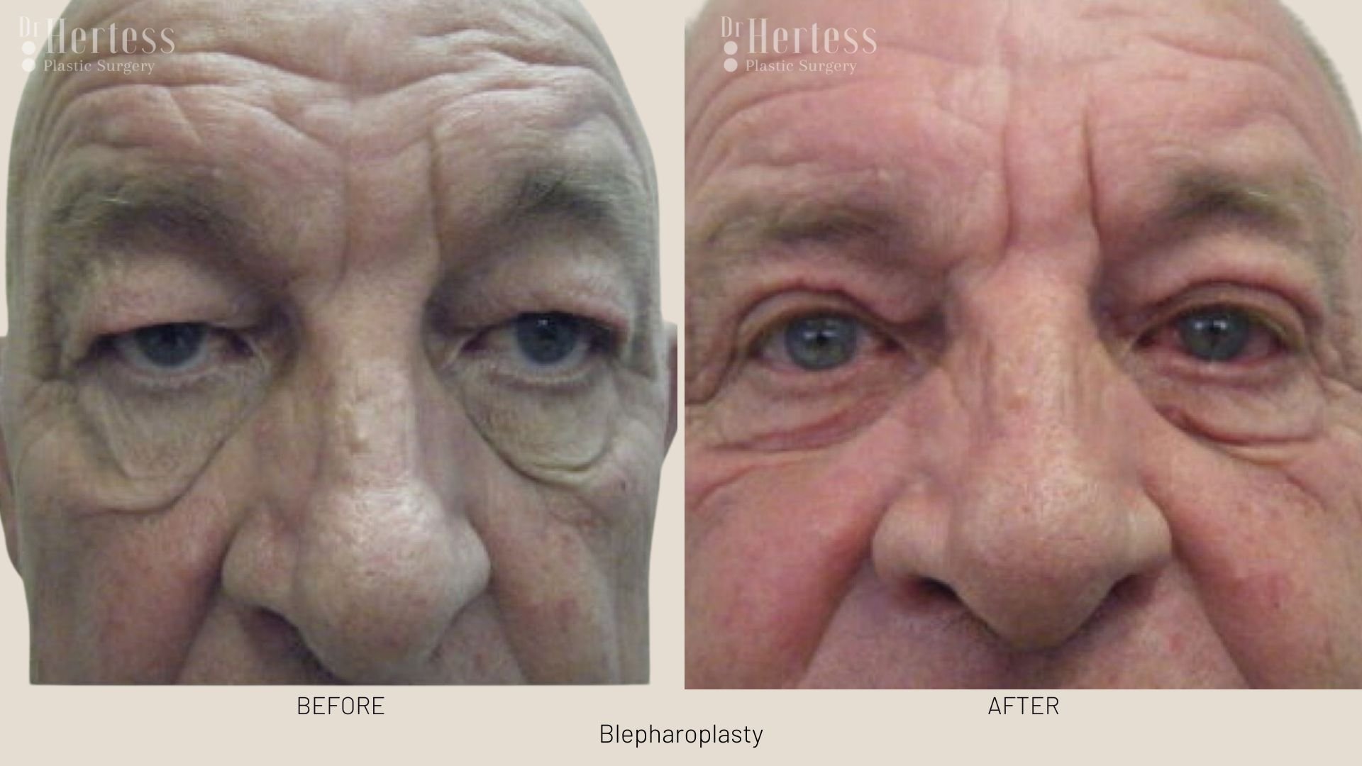 eye lift before and after