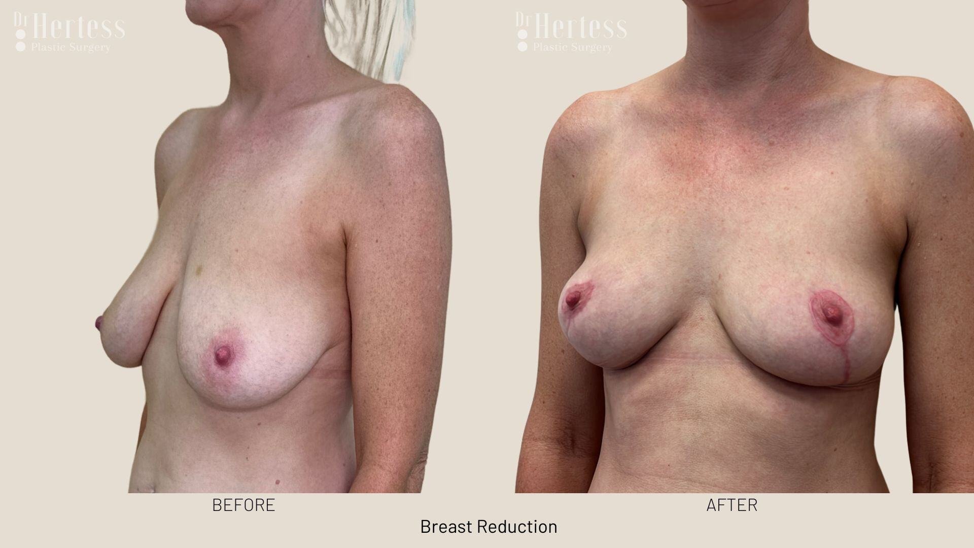 breast reduction photos