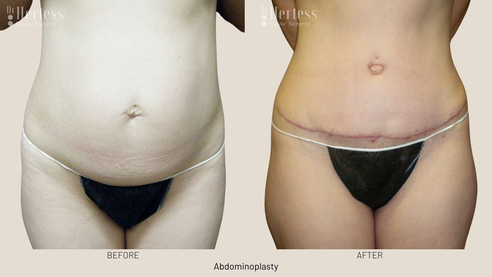 abdominoplasty before and after