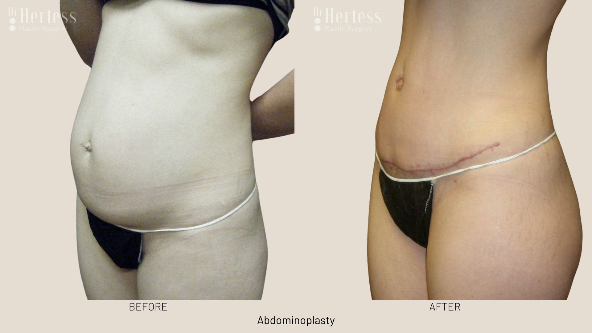 abdominoplasty before and after