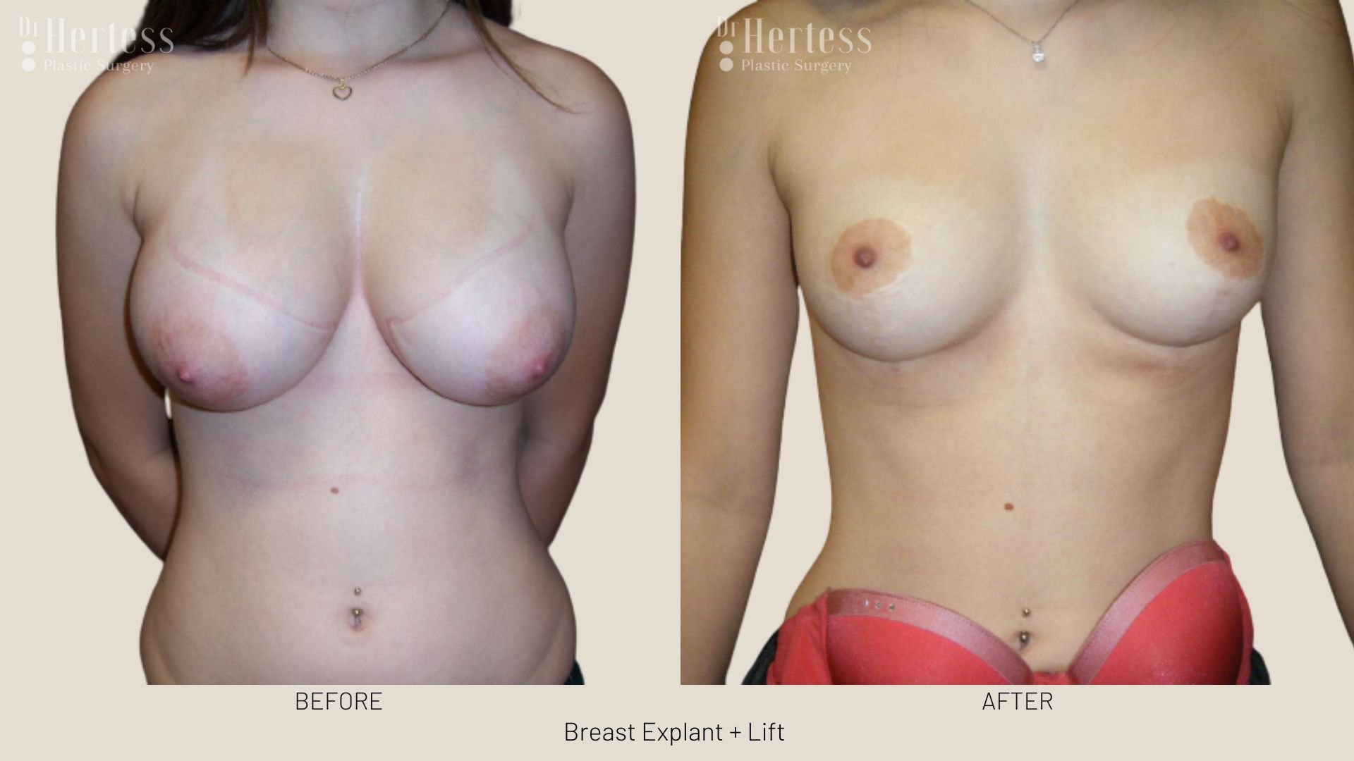 breast explant and lift before and after