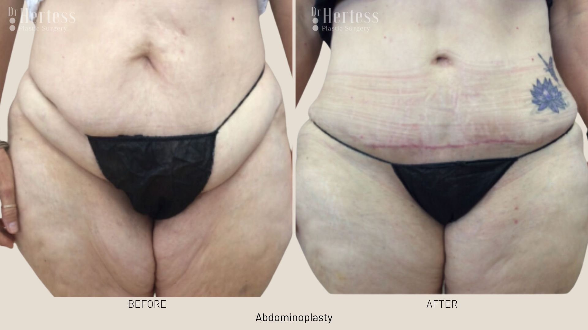 abdominoplasty before and after