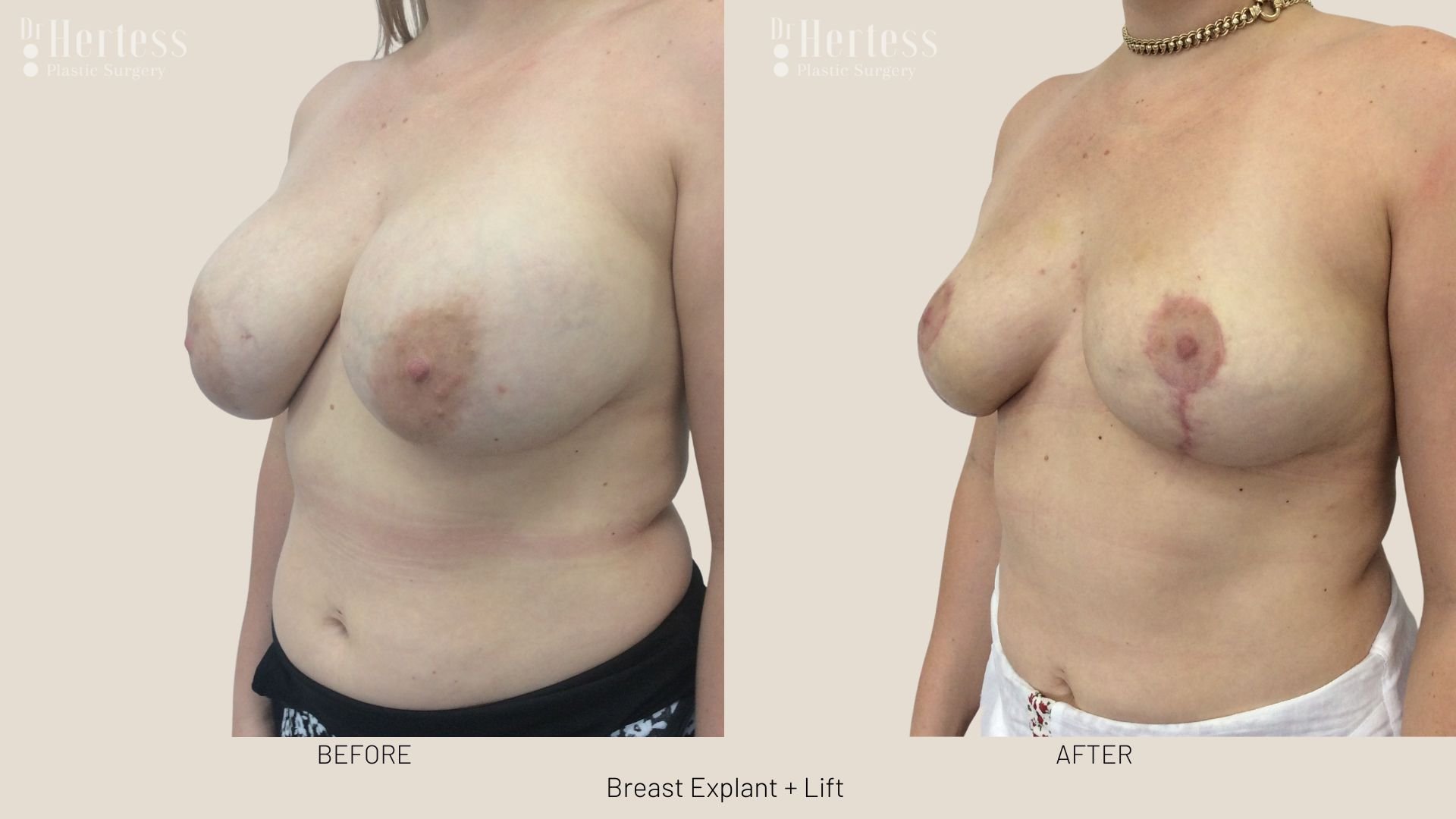 breast explant and lift before and after