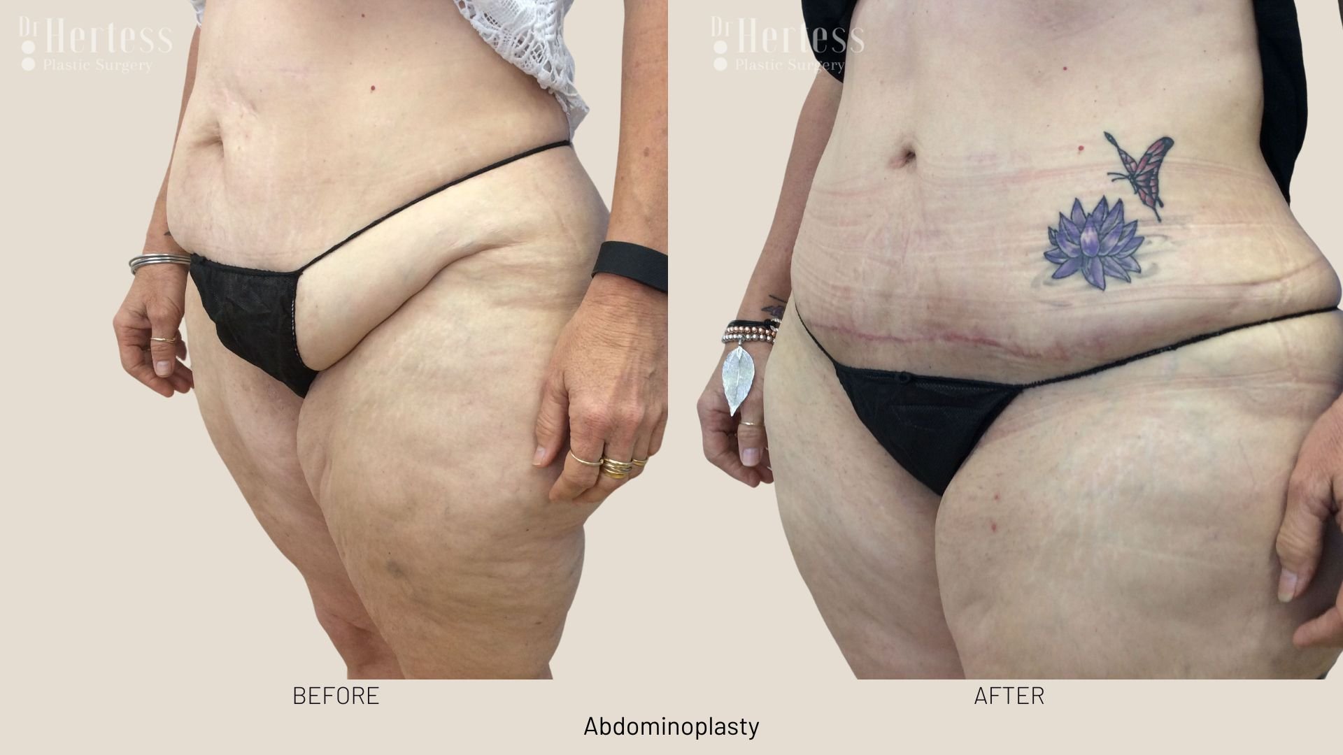 abdominoplasty before and after