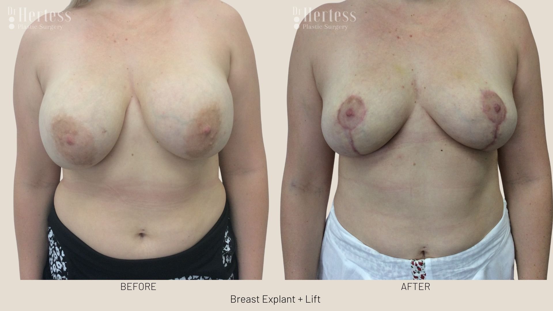 breast explant and lift before and after