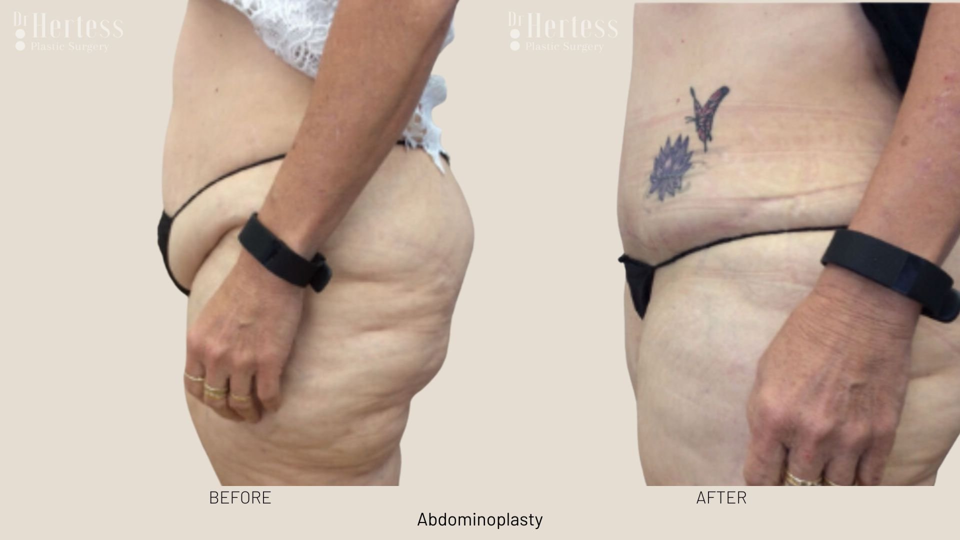 abdominoplasty before and after