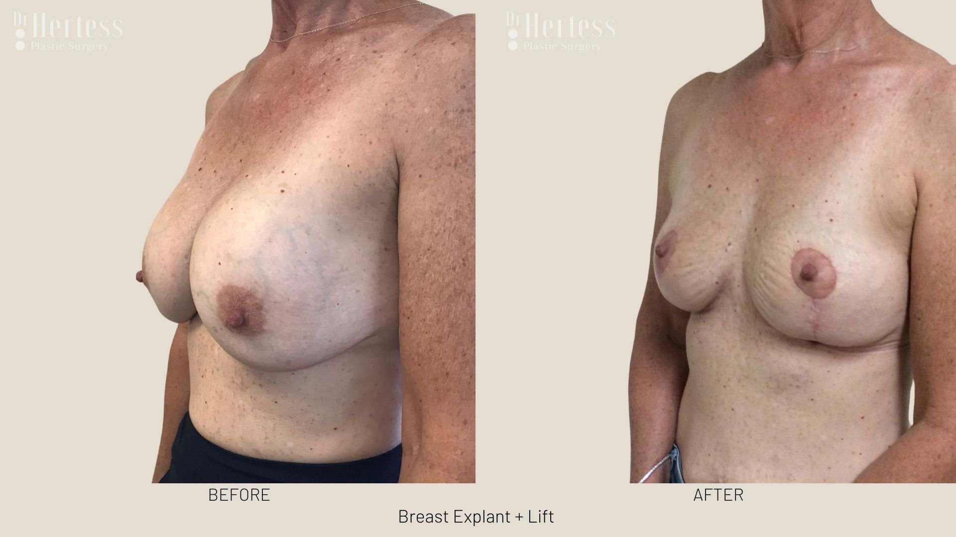 breast explant and lift before and after