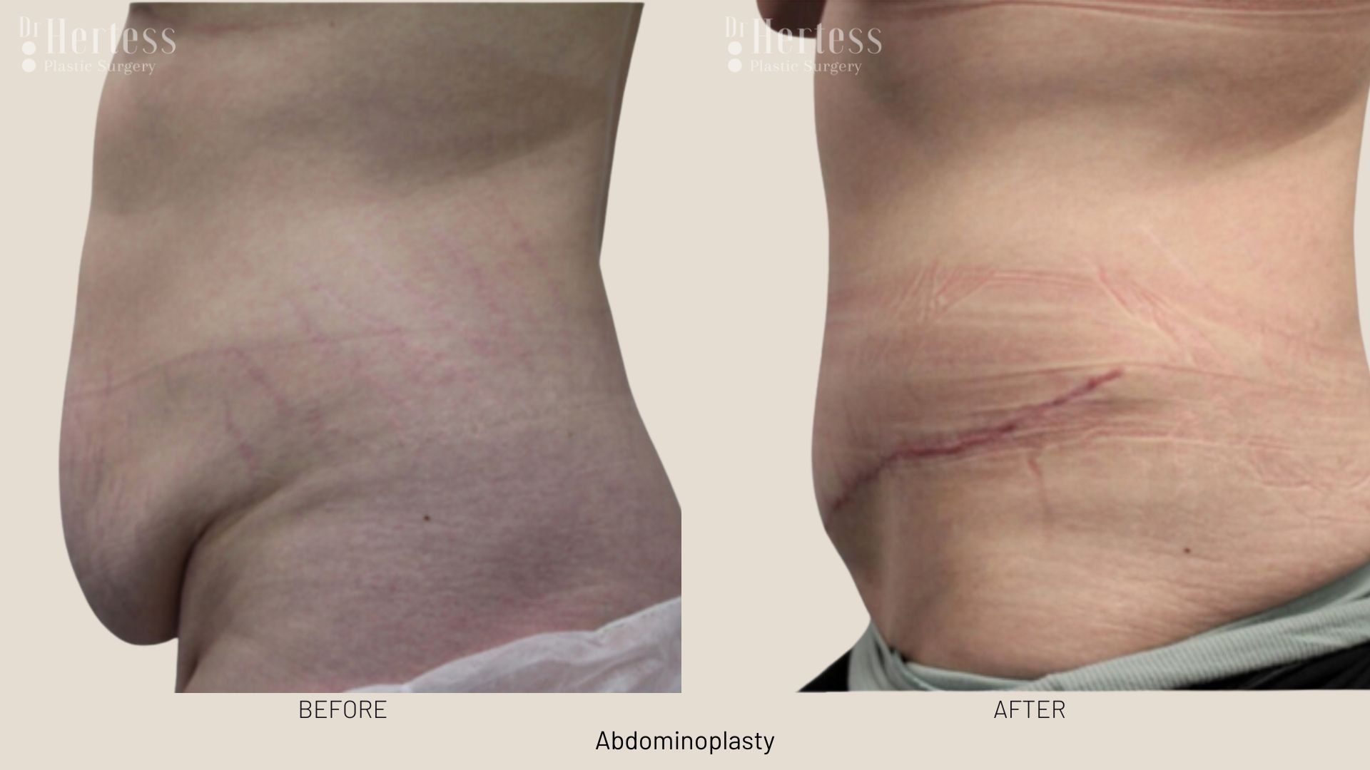 abdominoplasty before and after