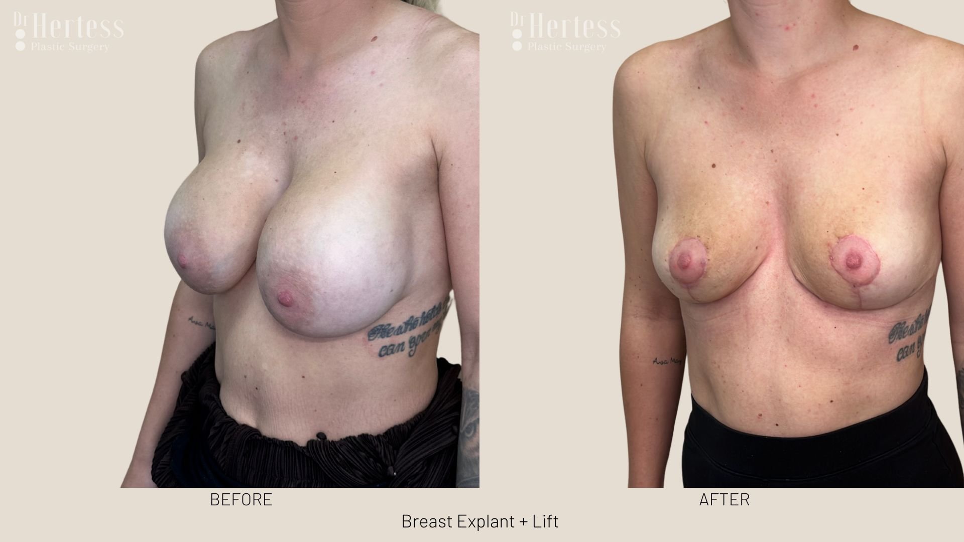 breast explant and lift before and after