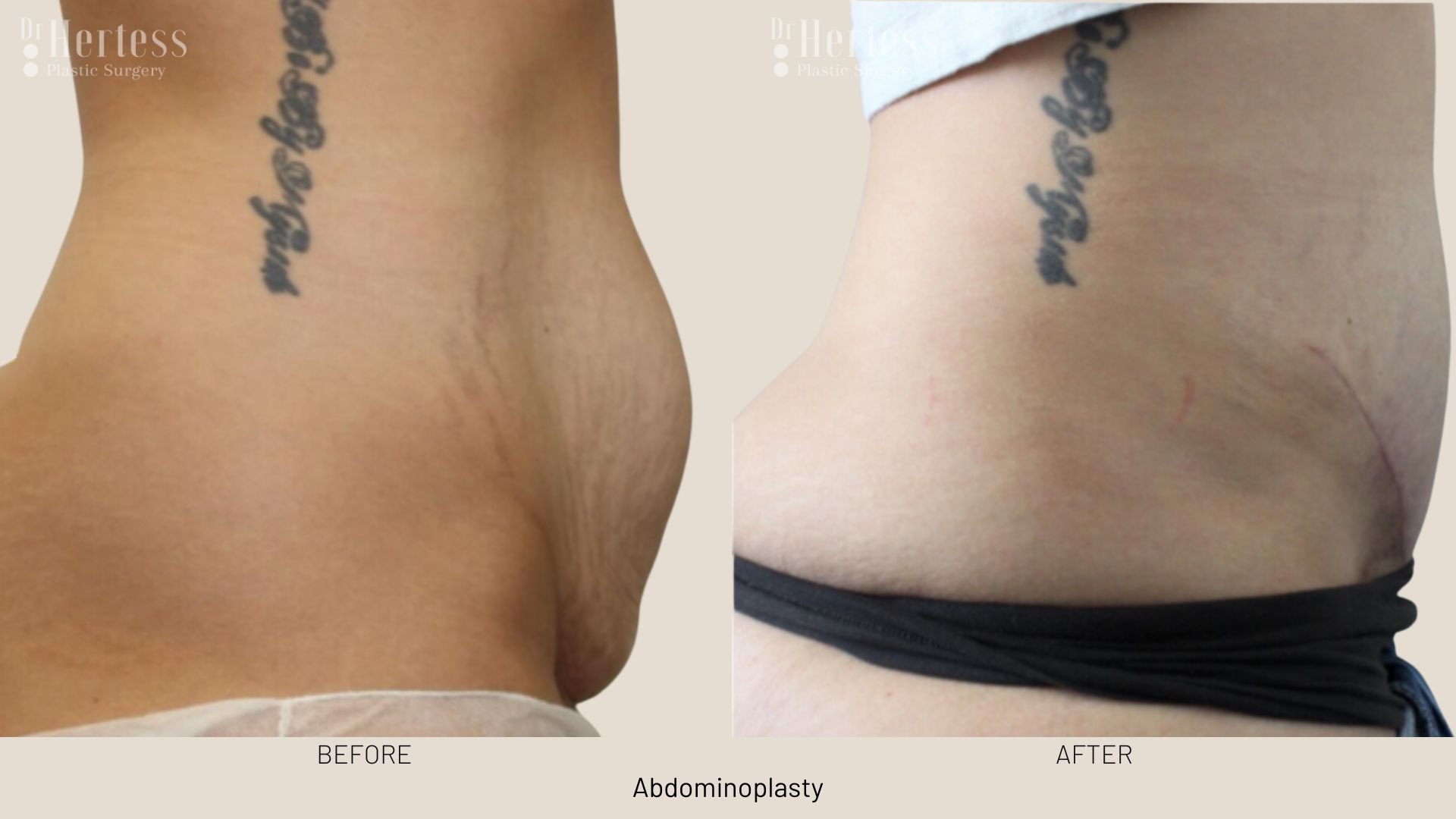 abdominoplasty before and after