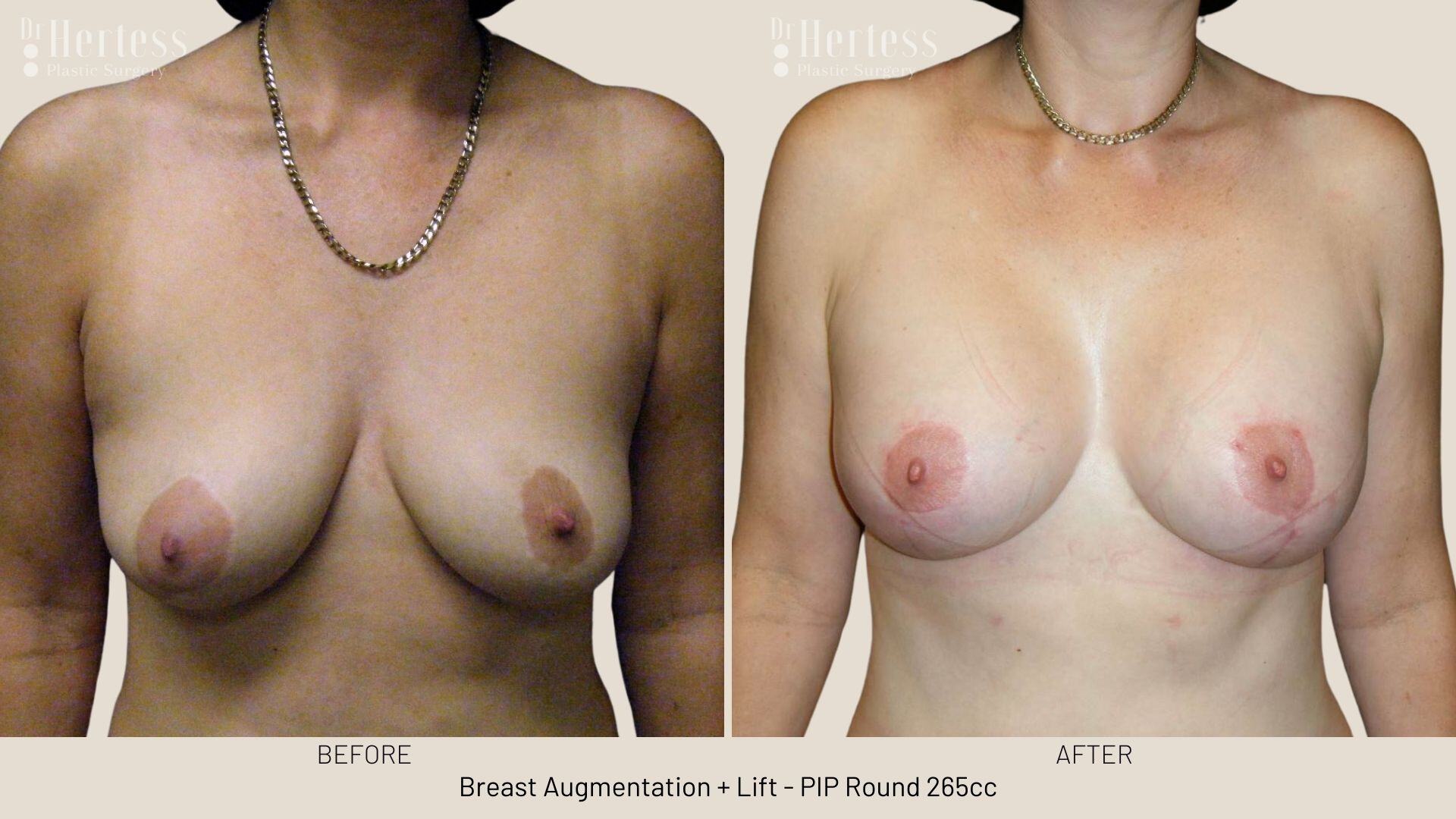 breast lift and implants photos