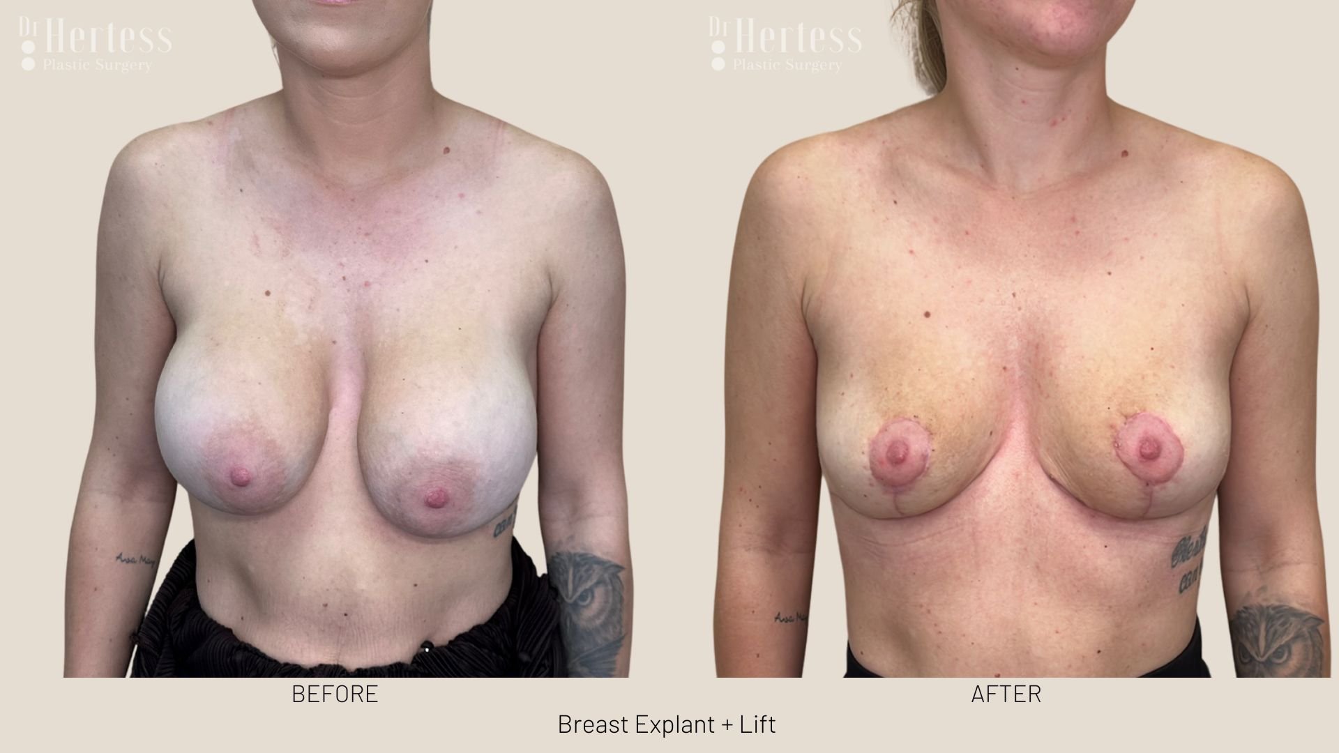 breast explant and lift before and after