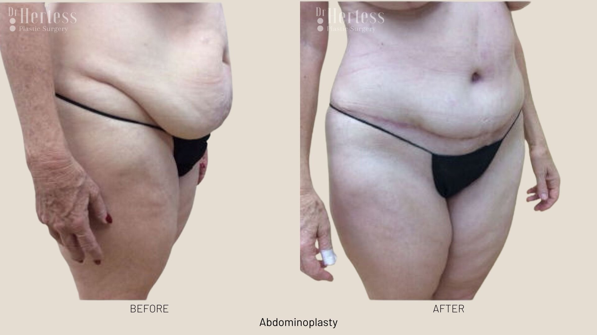 abdominoplasty before and after