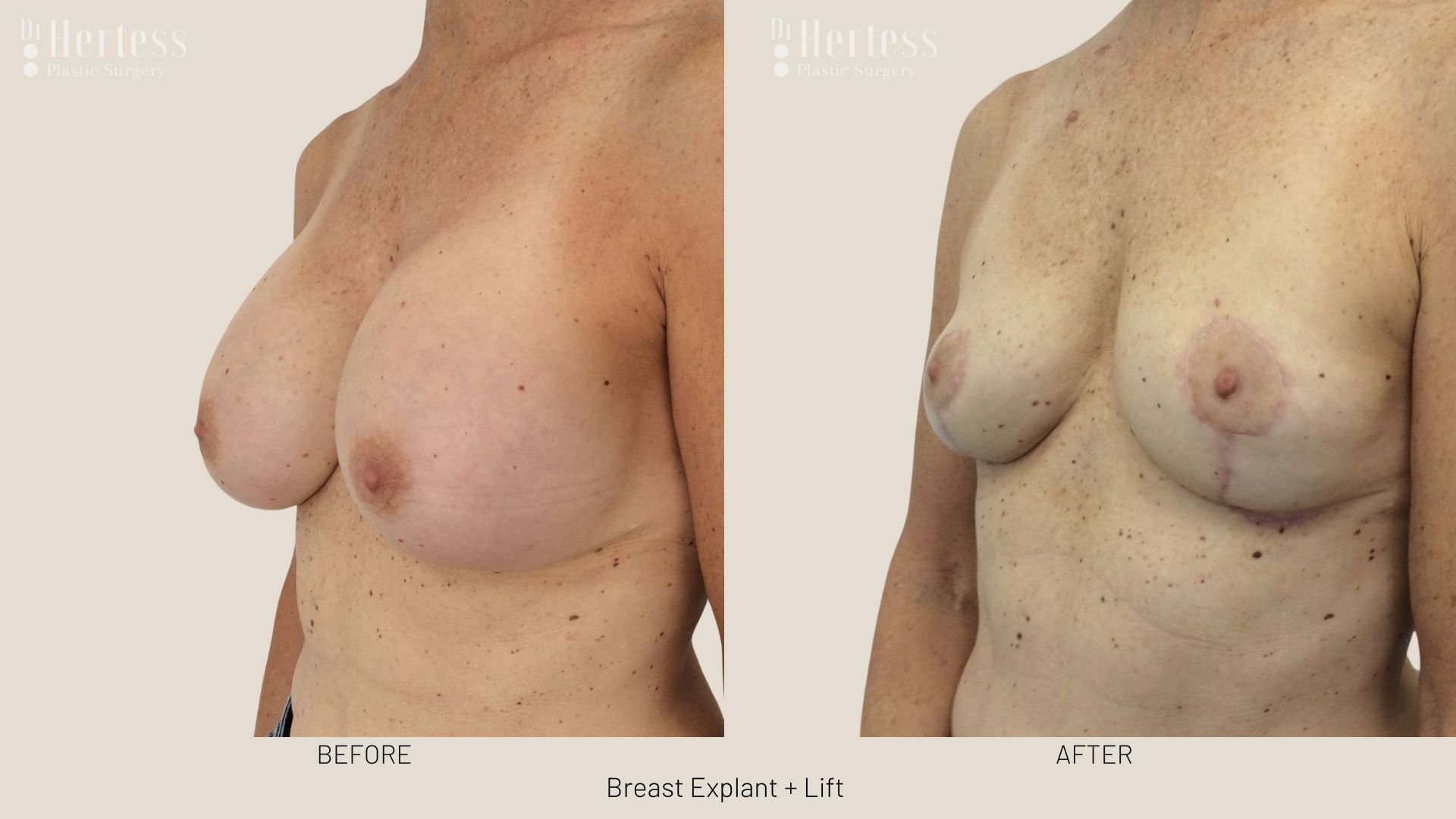 breast explant and lift before and after