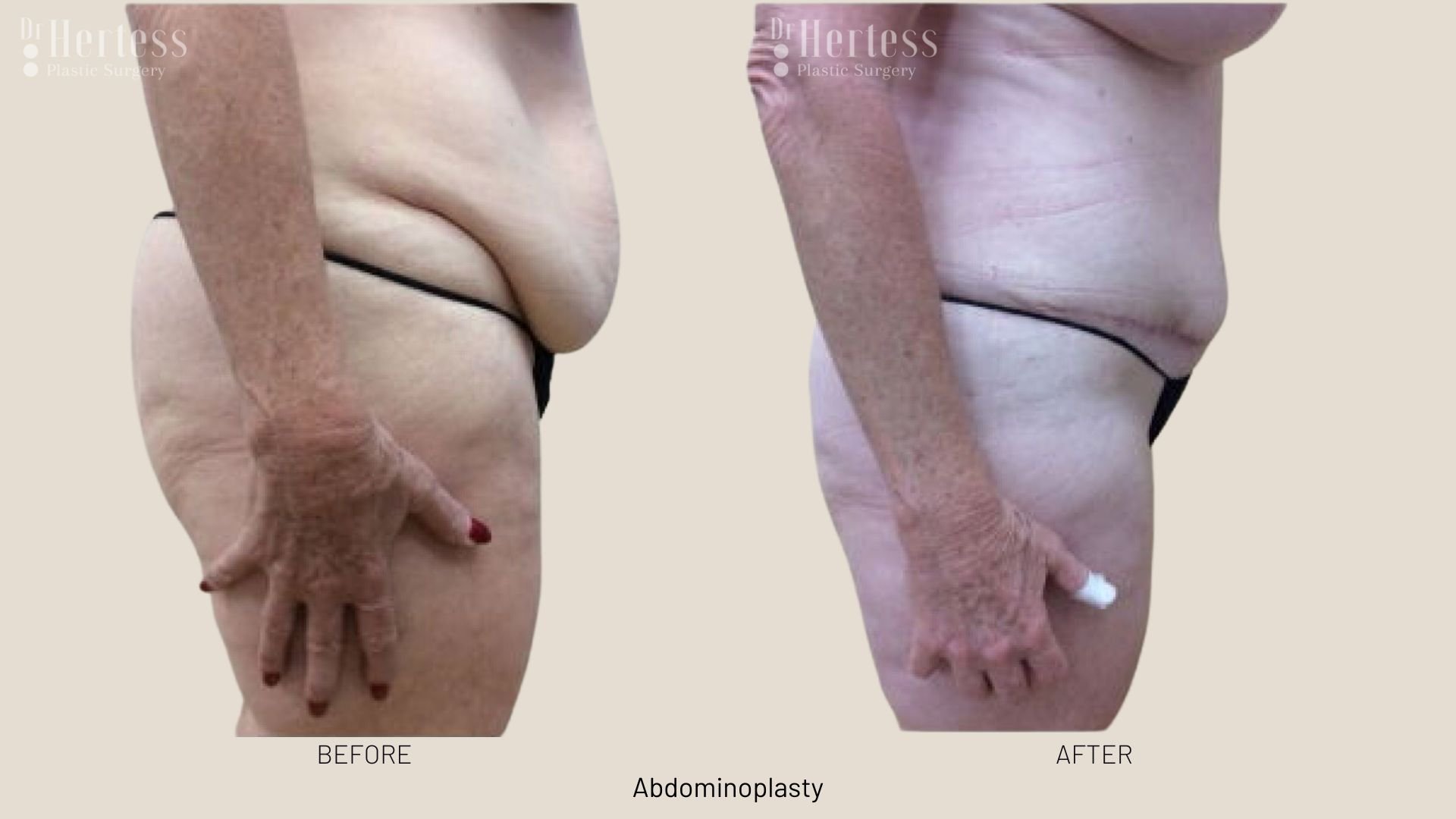 abdominoplasty before and after