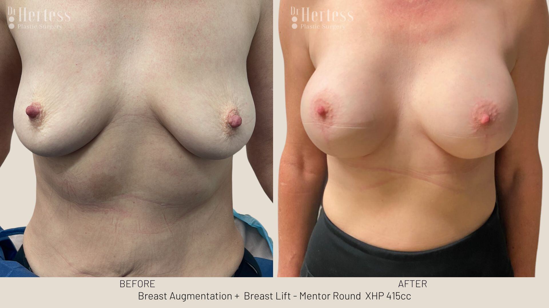 breast implants and lift before and after