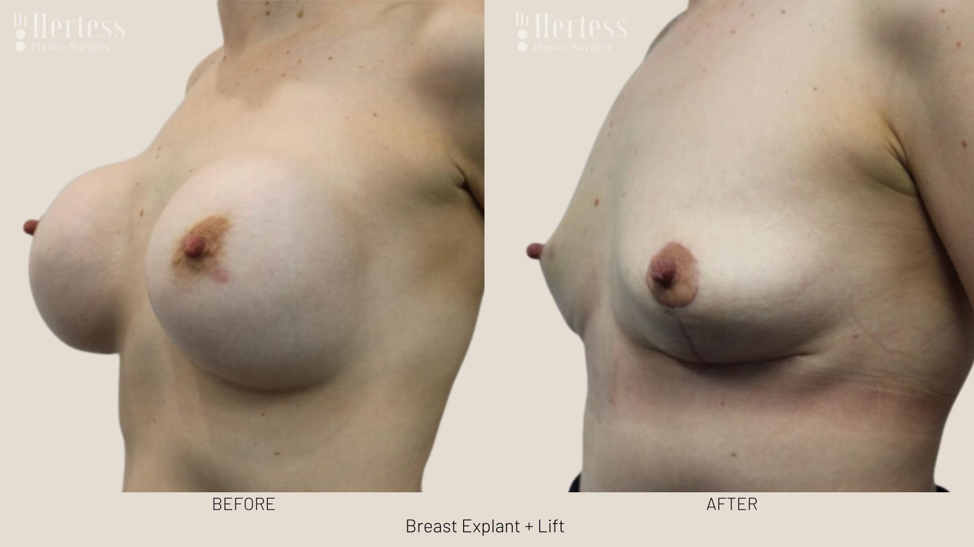 breast explant and lift before and after