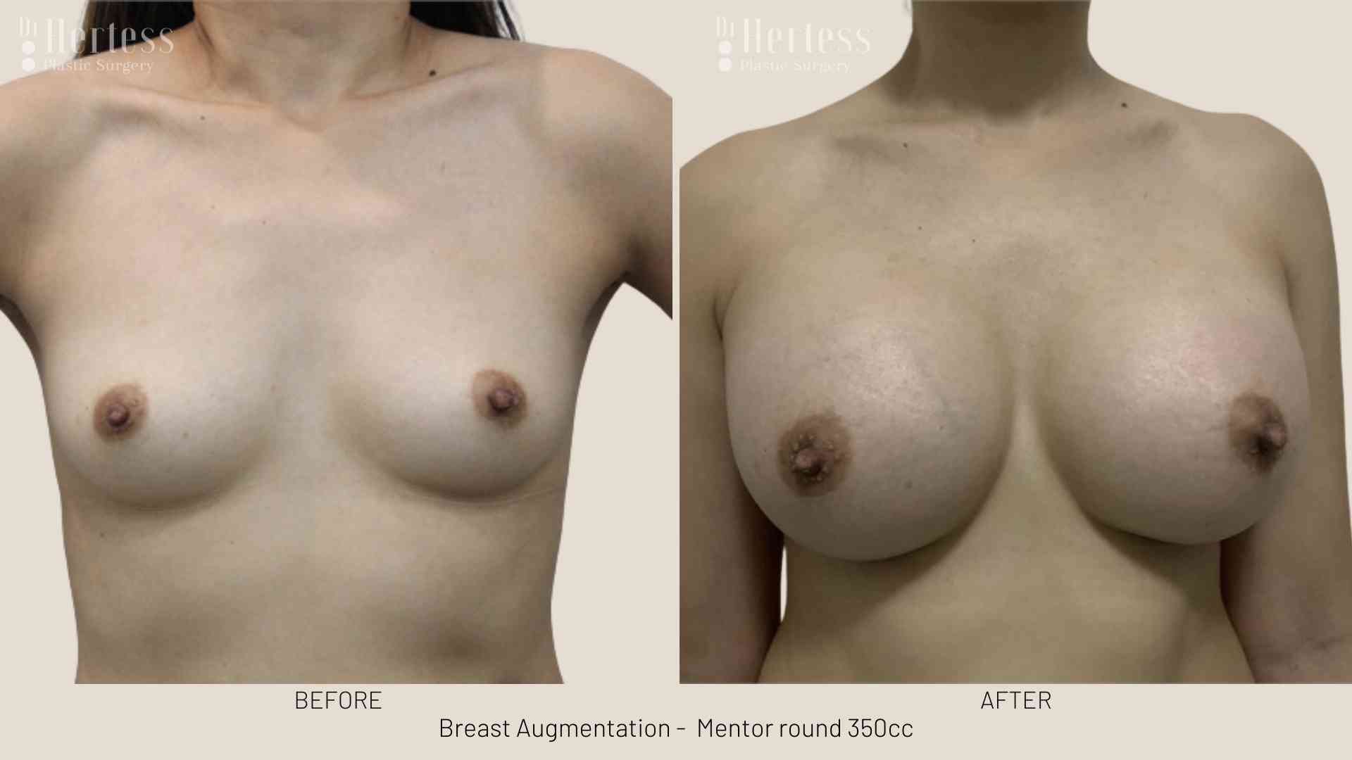 breast implant pictures