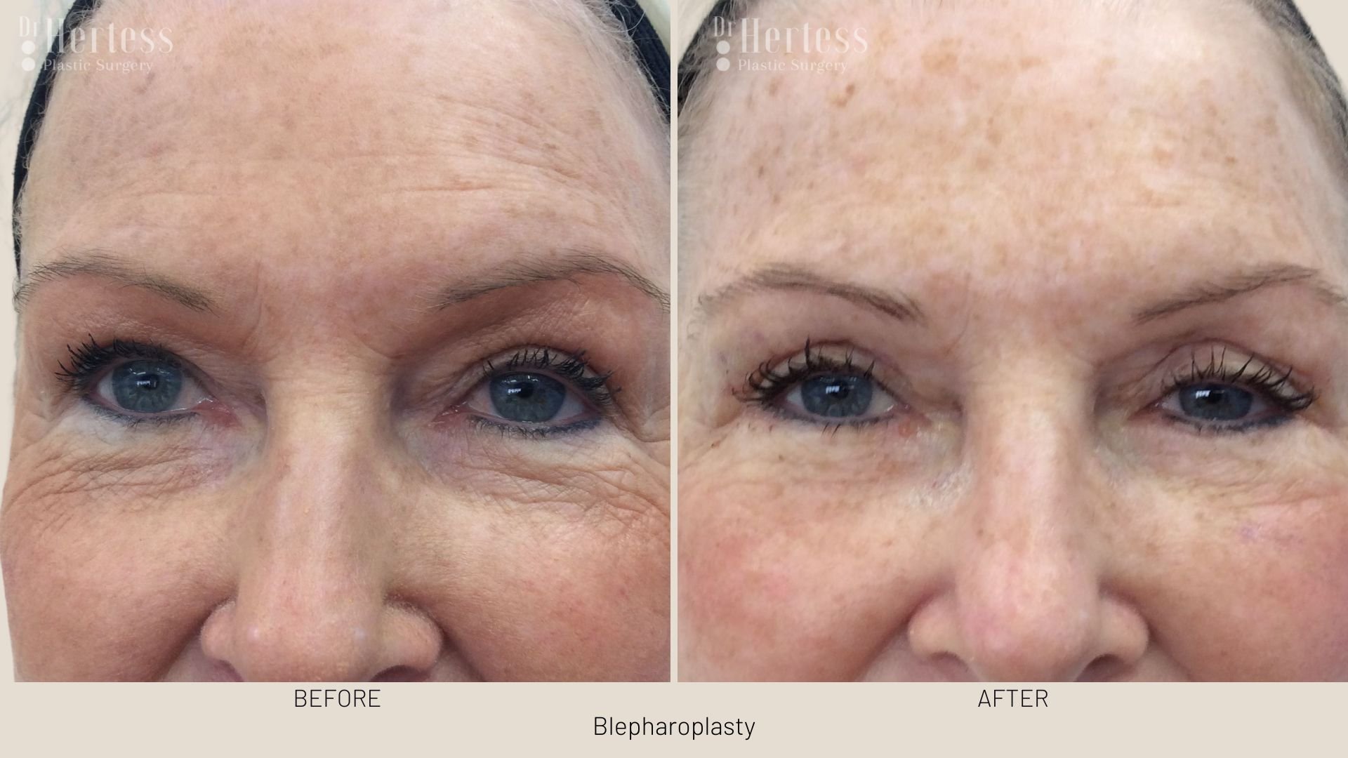 eye lift before and after