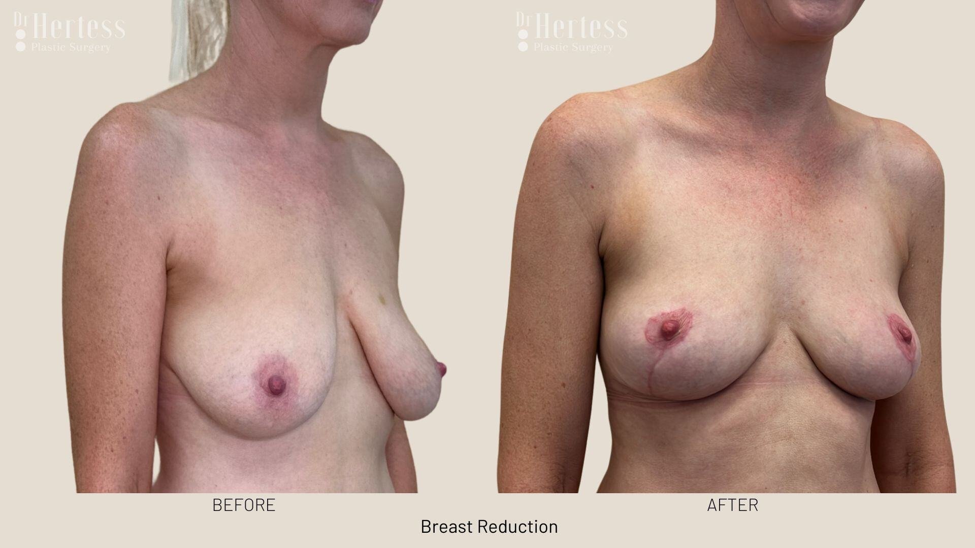 breast reduction photos