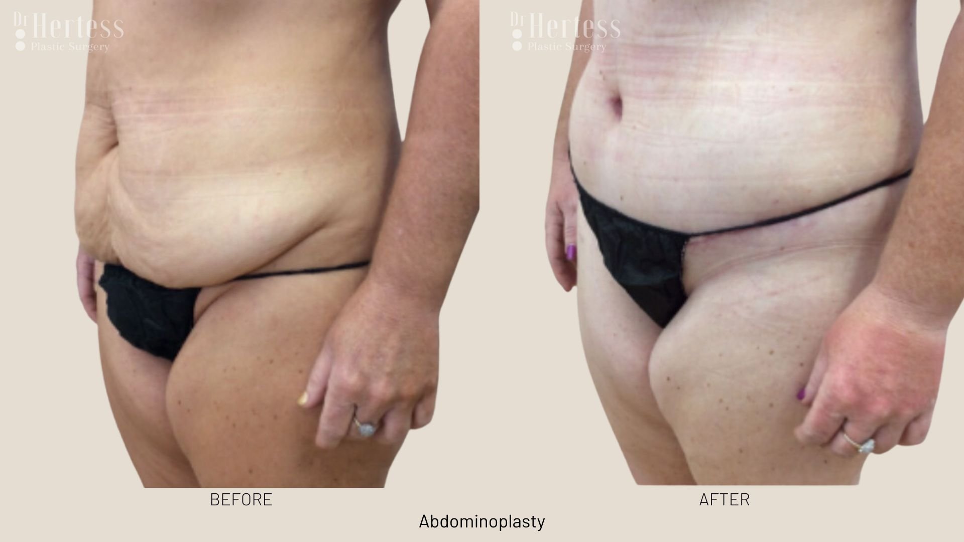 tummy tuck surgery before and after