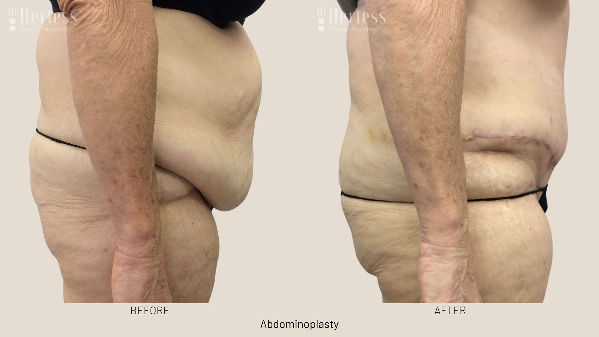 tummy tuck surgery before and after