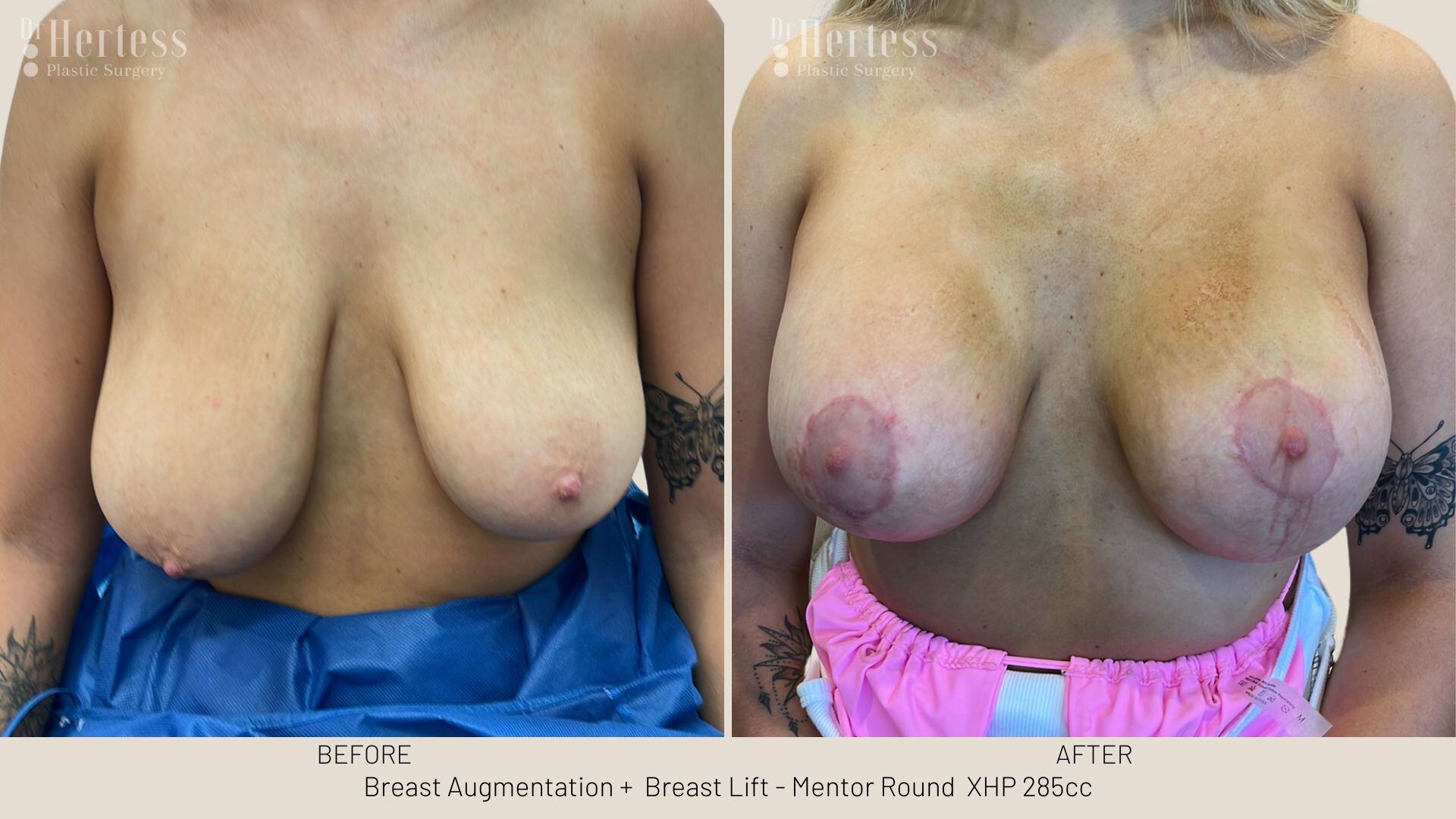 breast implants and lift before and after