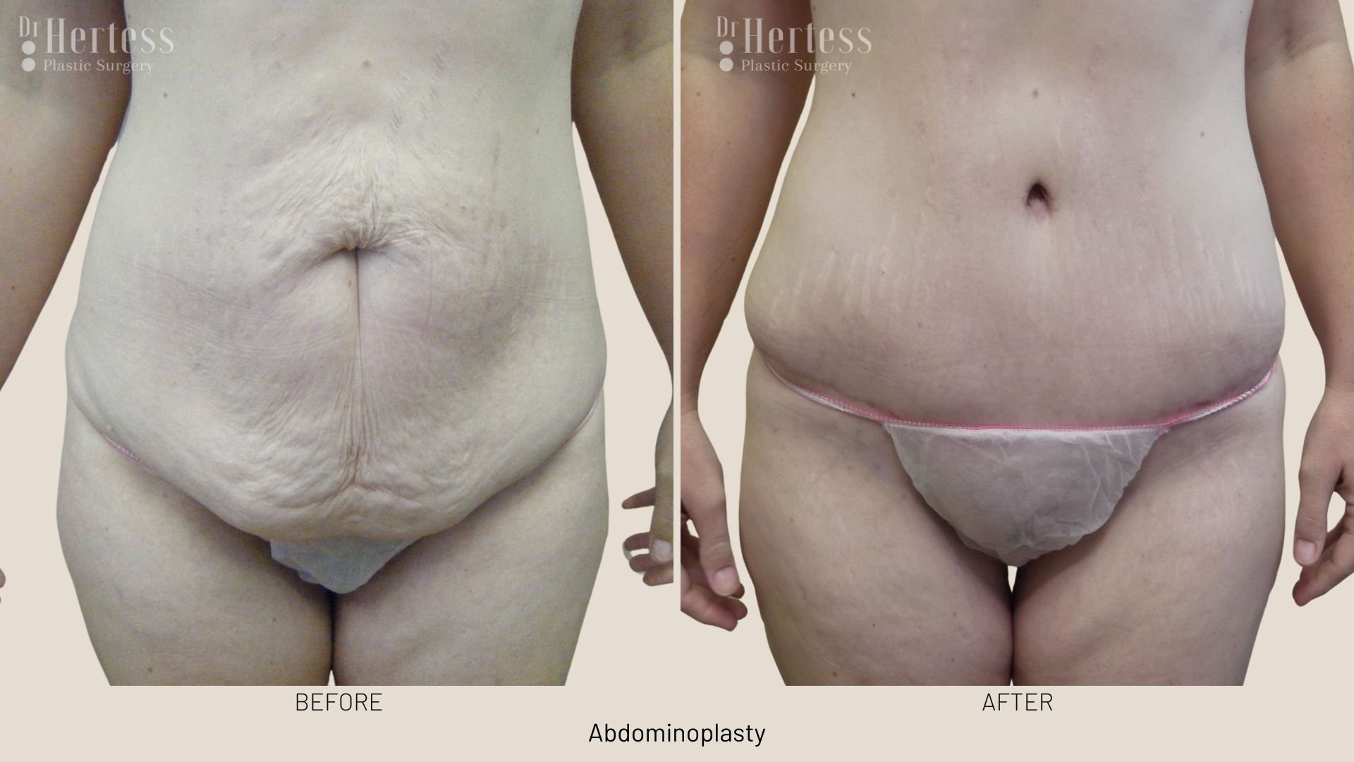 tummy tuck surgery before and after