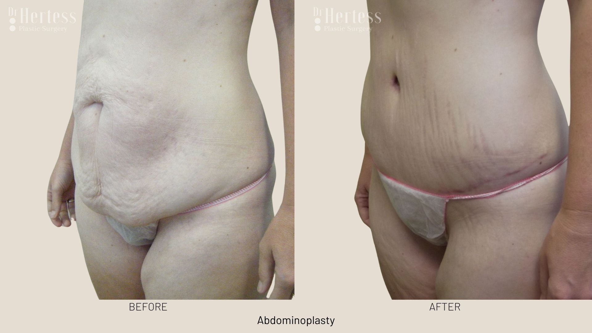 tummy tuck surgery before and after