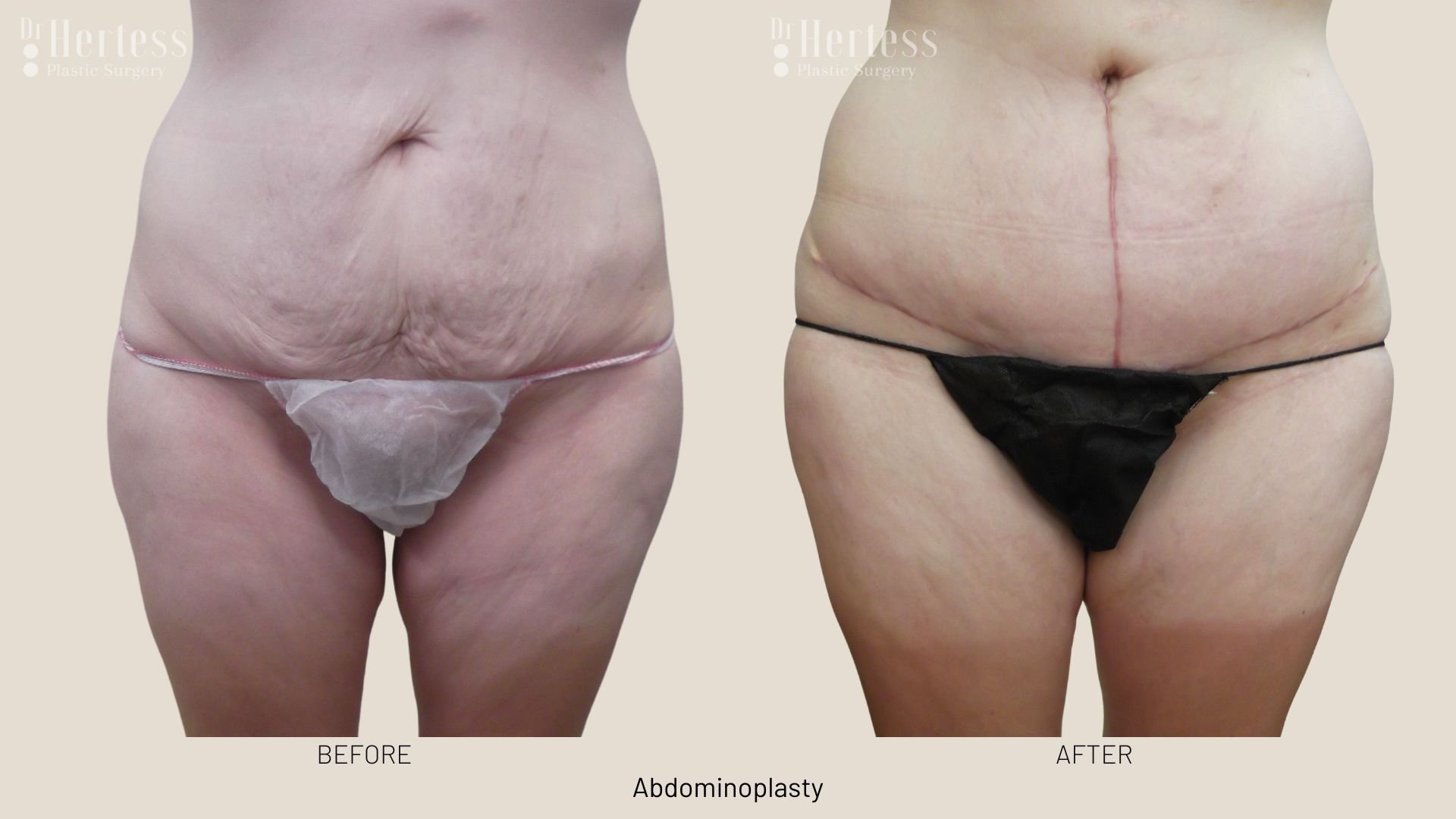 tummy tuck surgery before and after