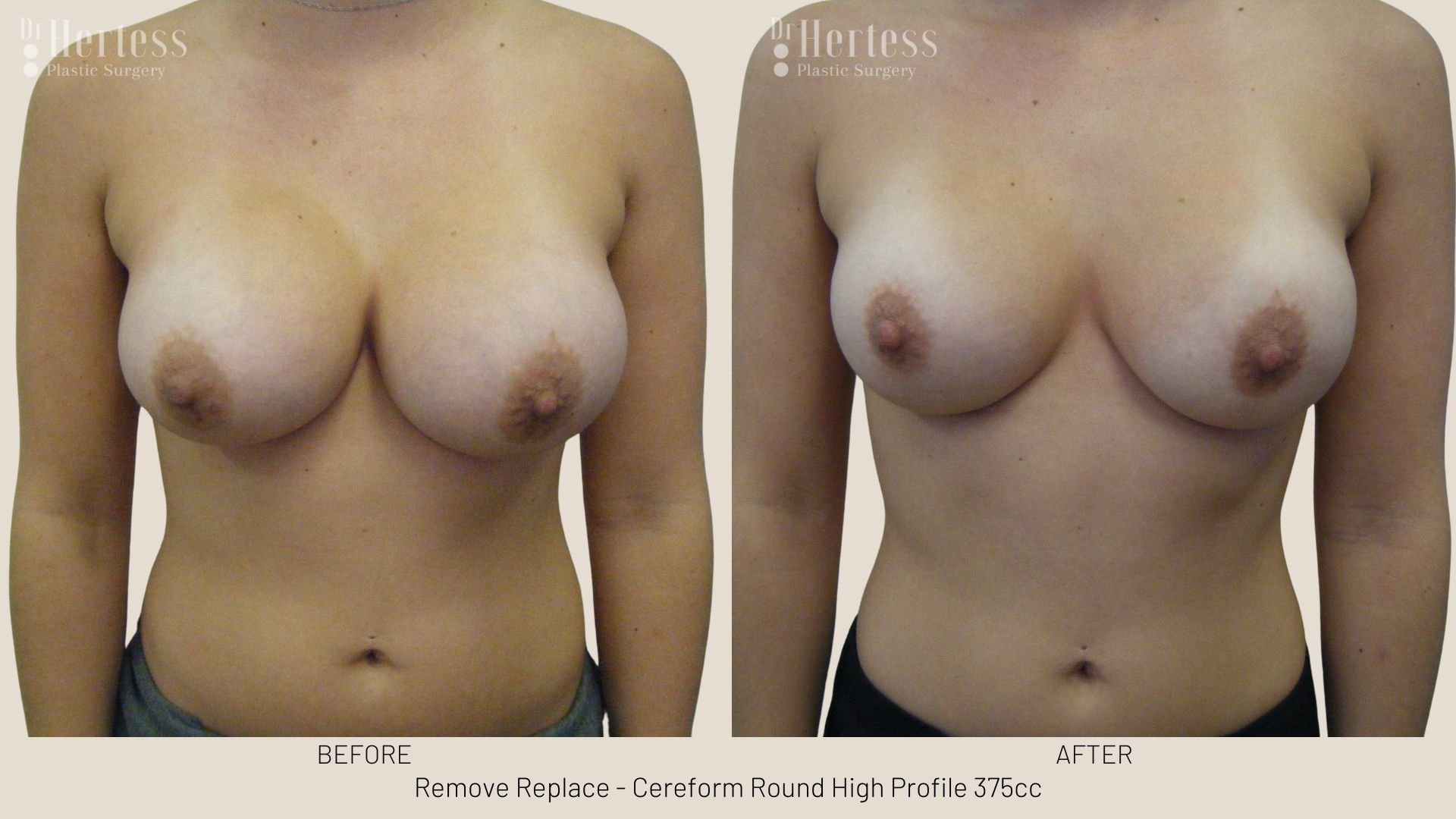 breast implant removal and replacement