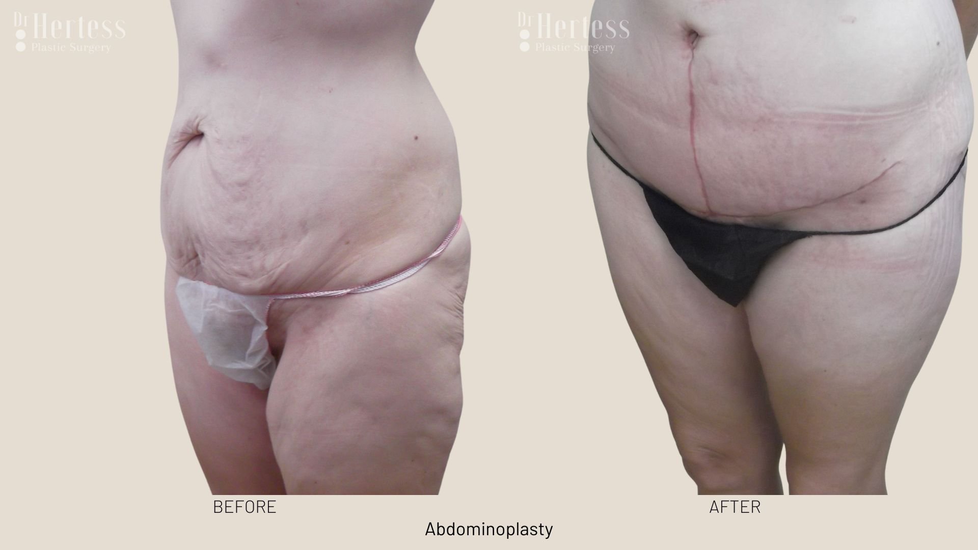 tummy tuck surgery before and after