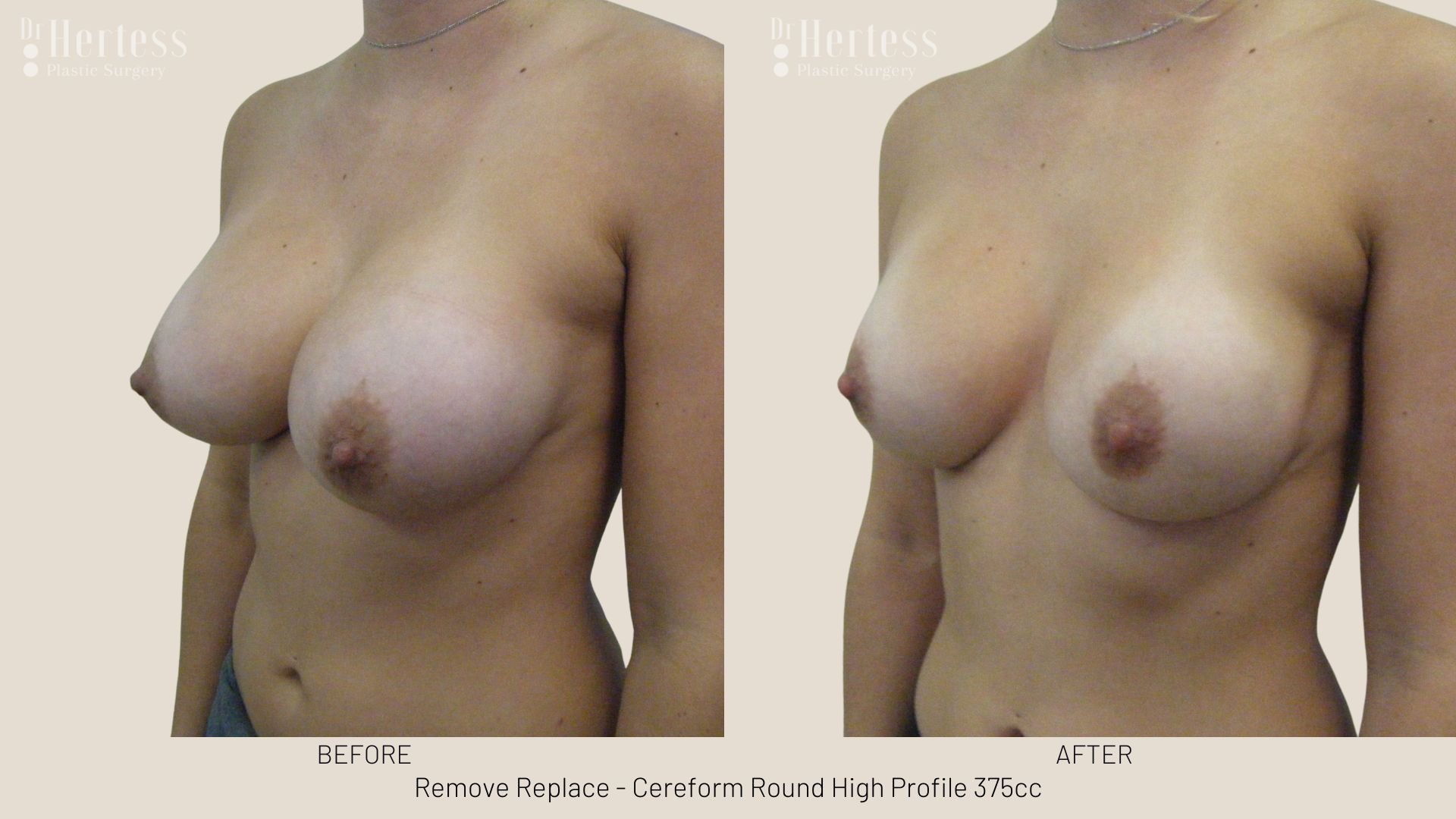 breast implant removal and replacement