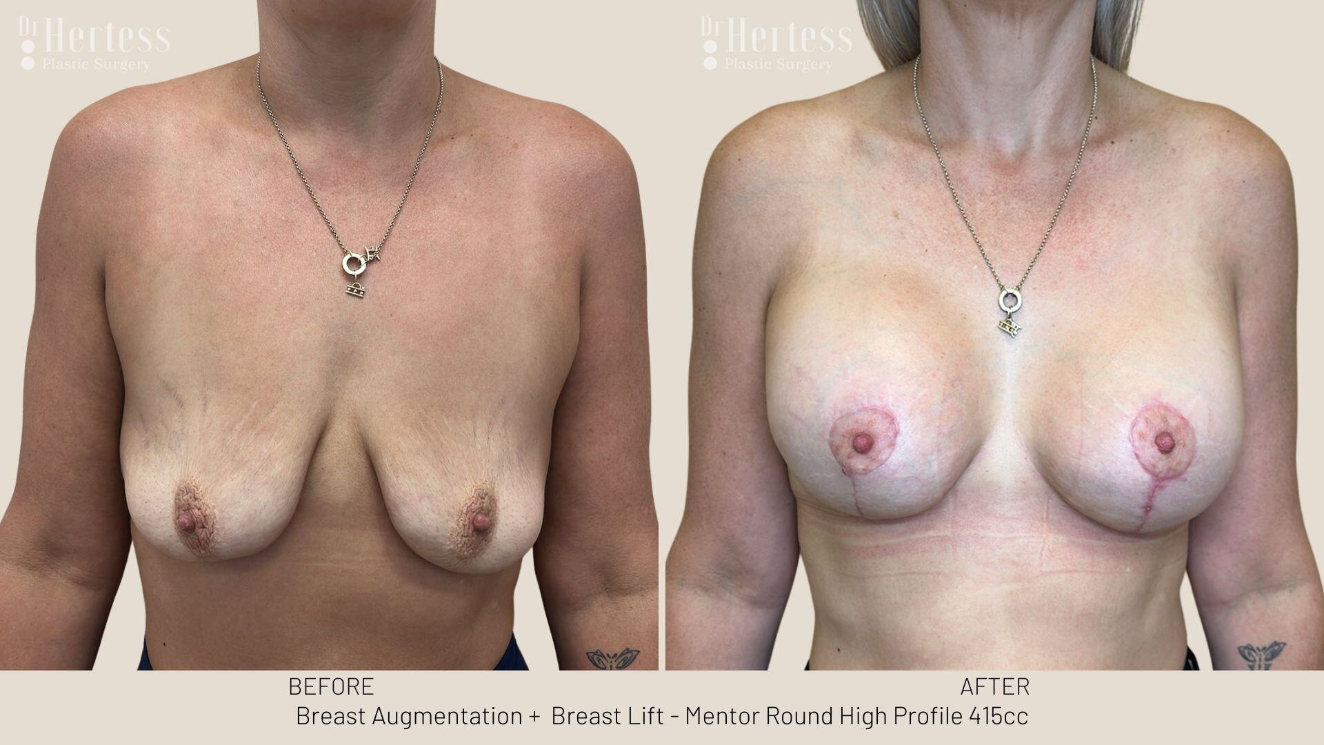 breast lift with implants