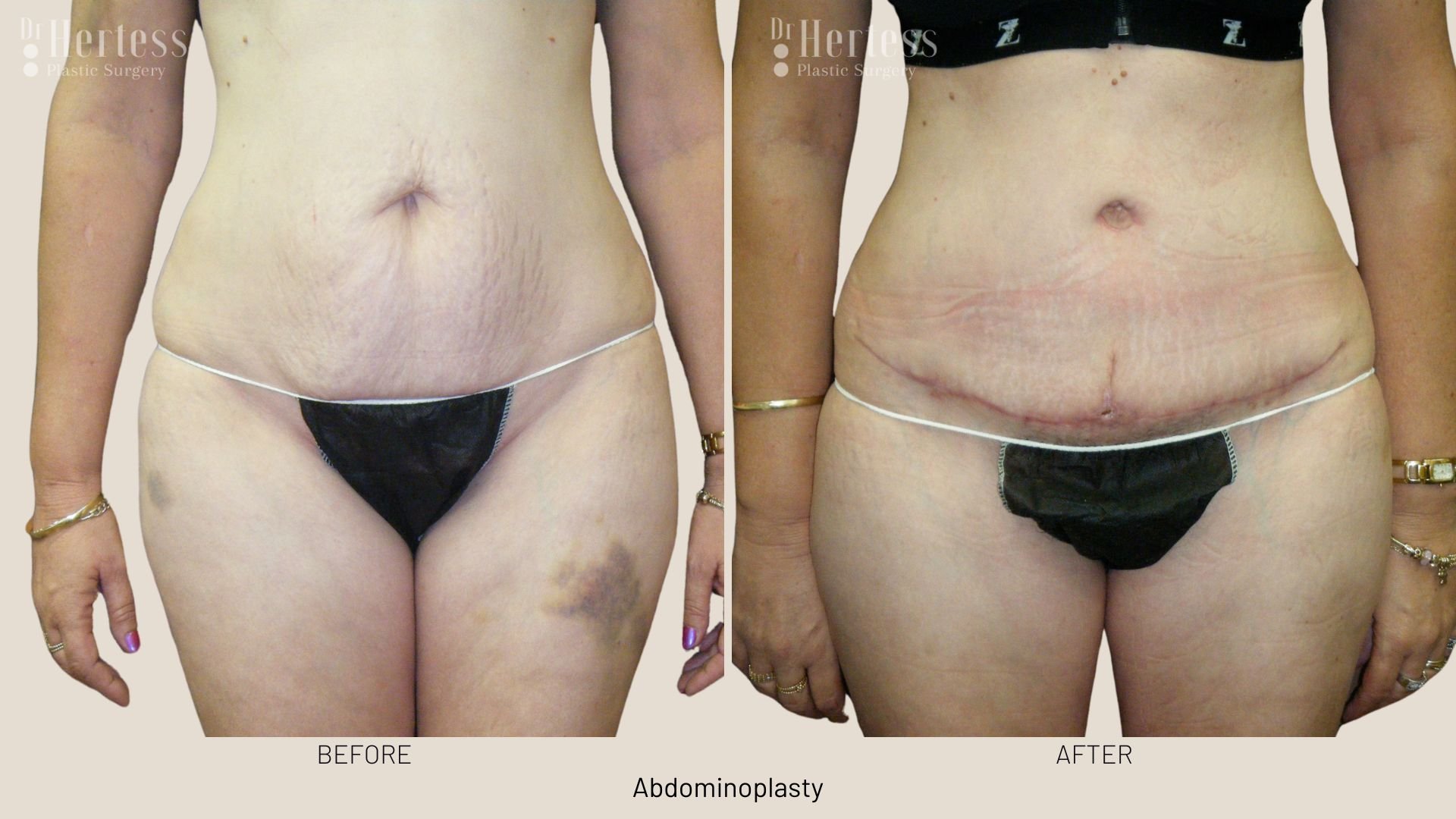 tummy tuck surgery before and after