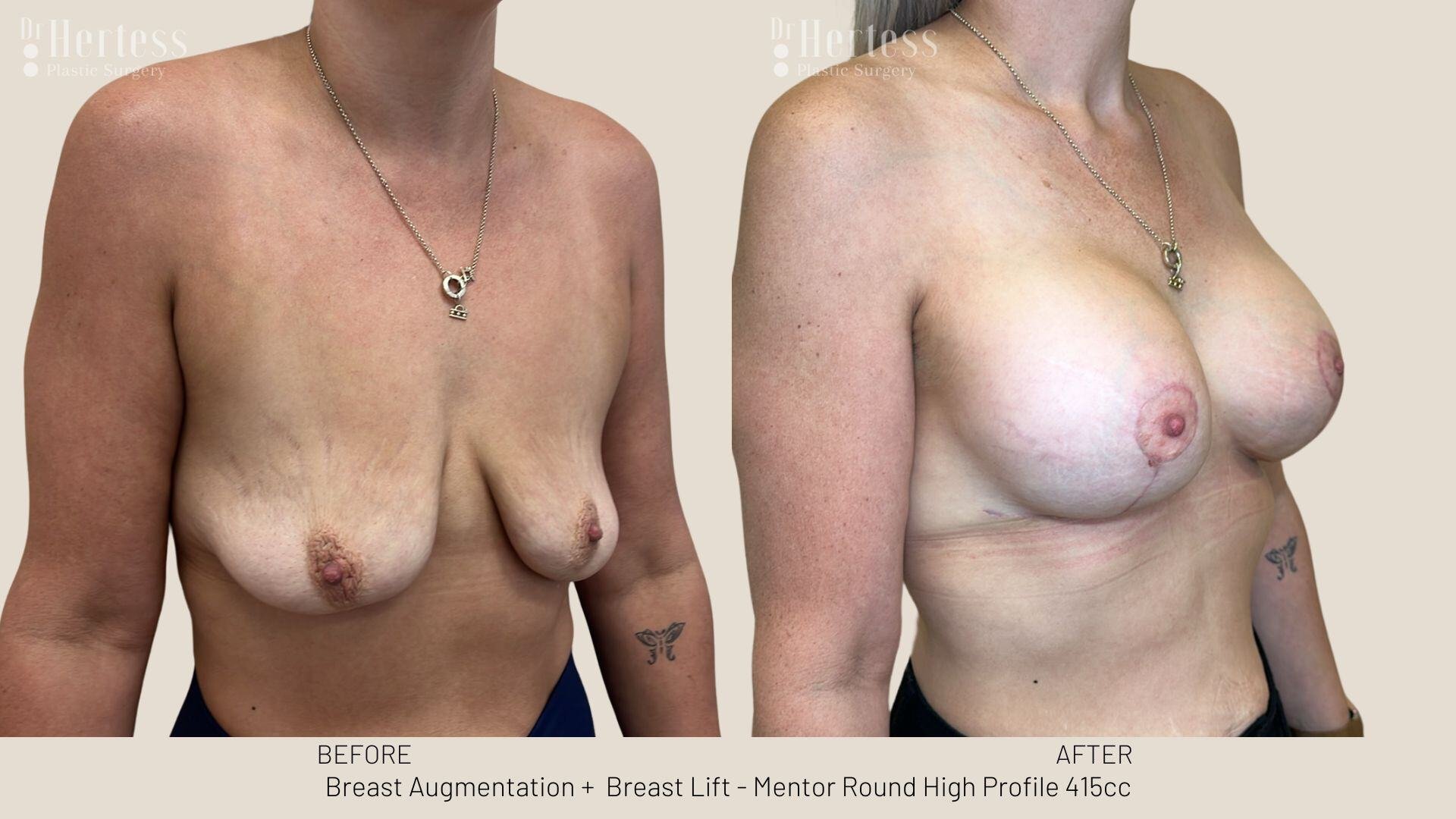 breast lift with implants