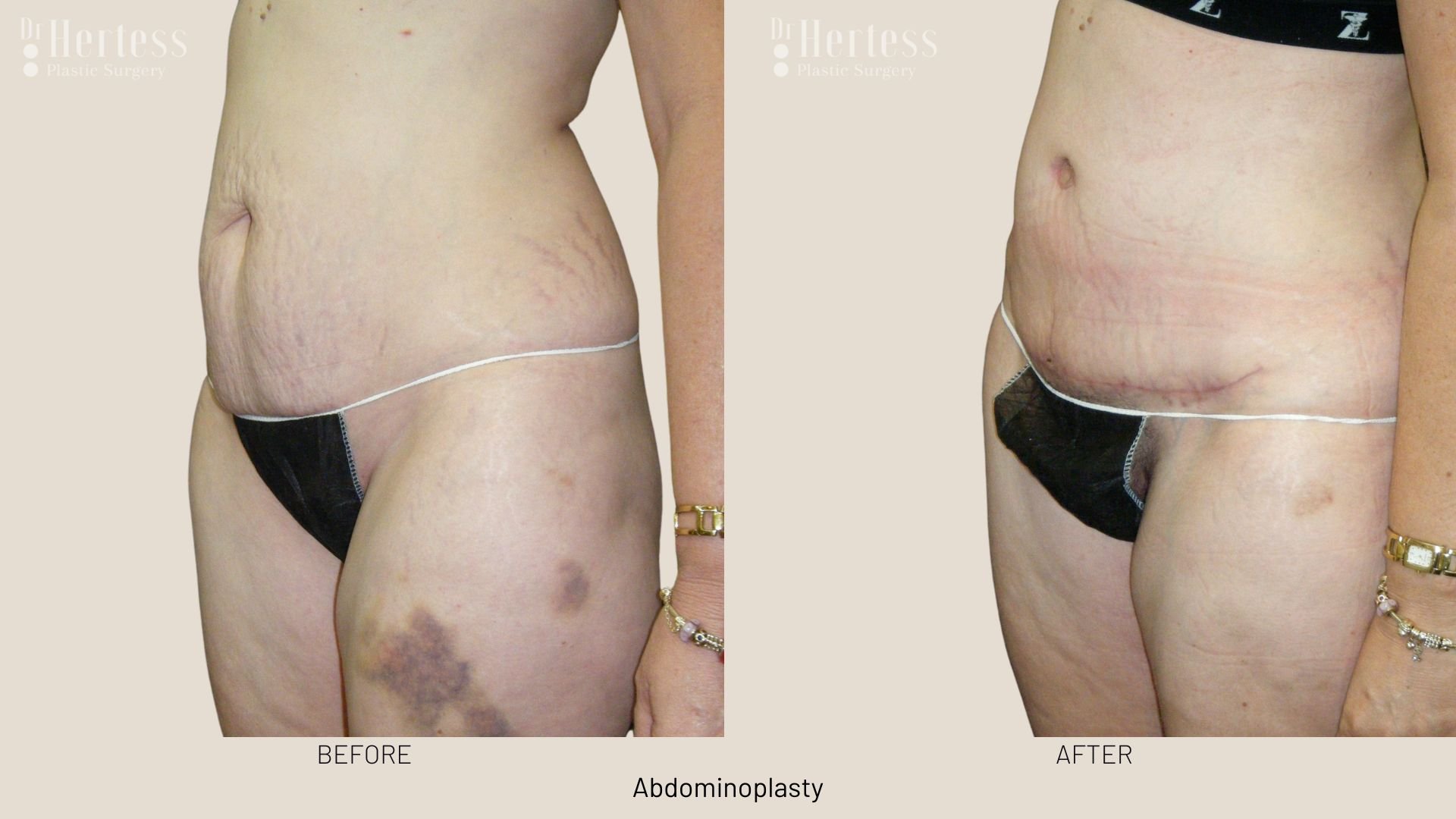 tummy tuck surgery before and after