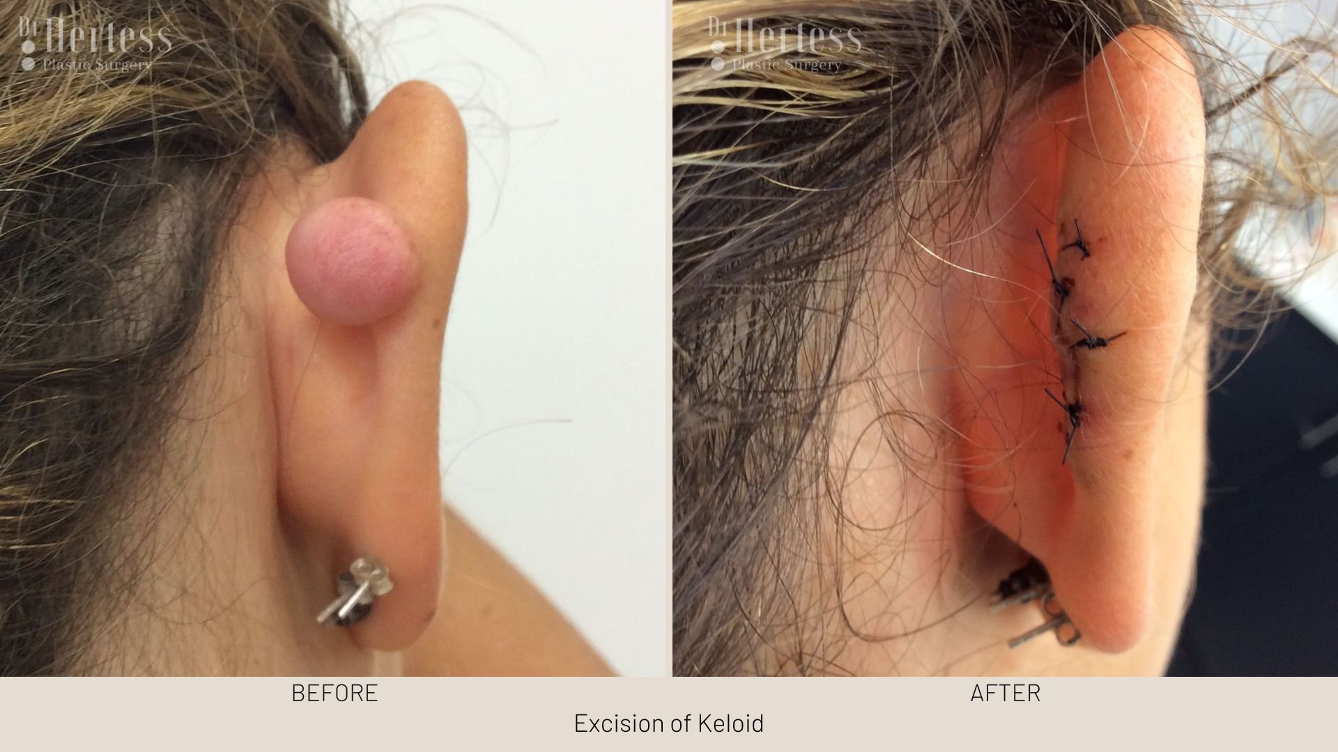 keloid scar removal