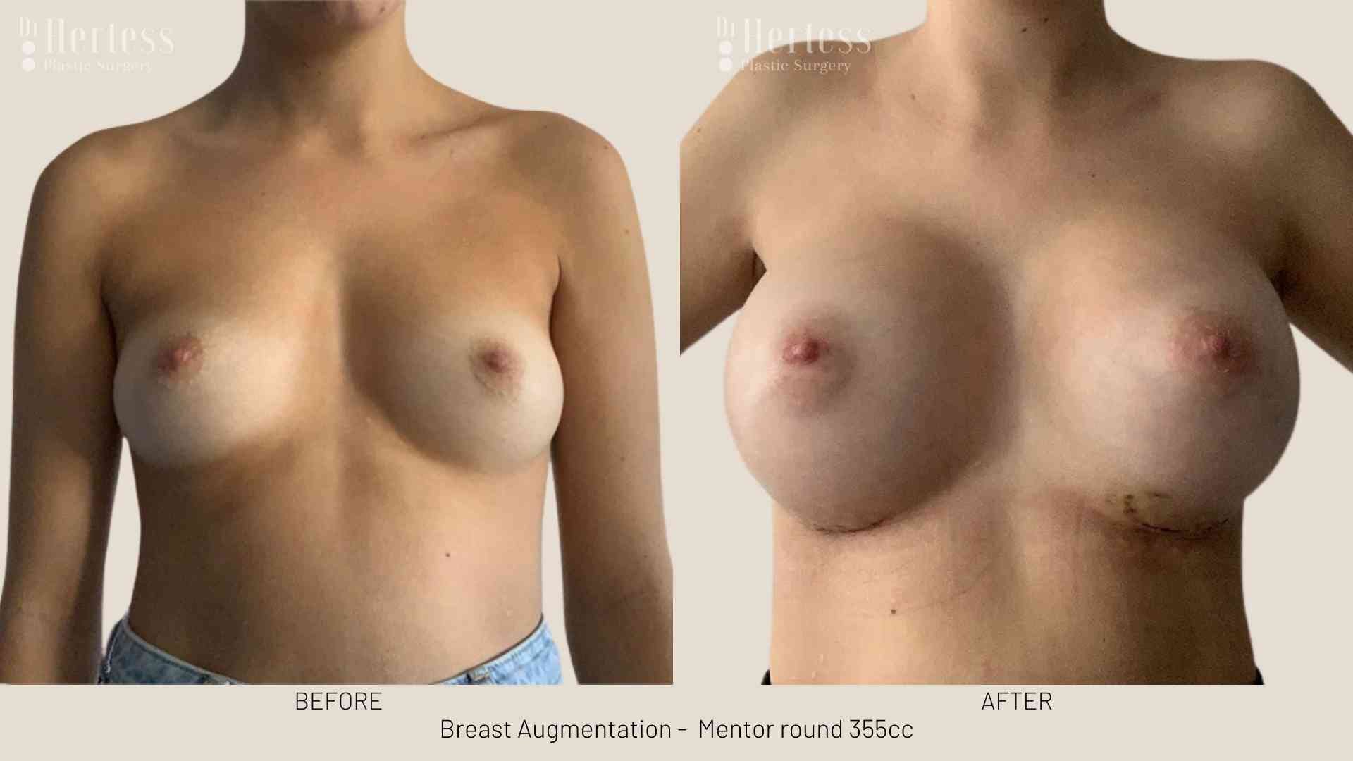 breast implant pictures