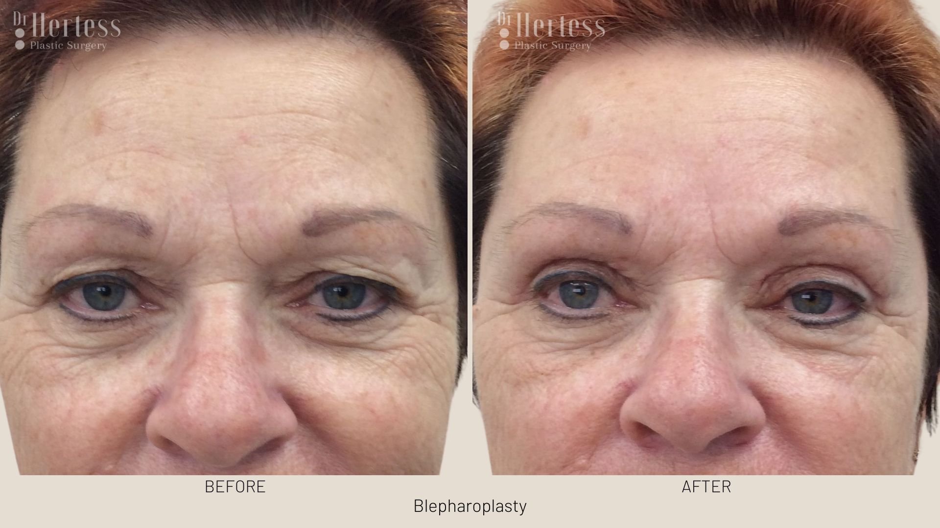 eye lift before and after