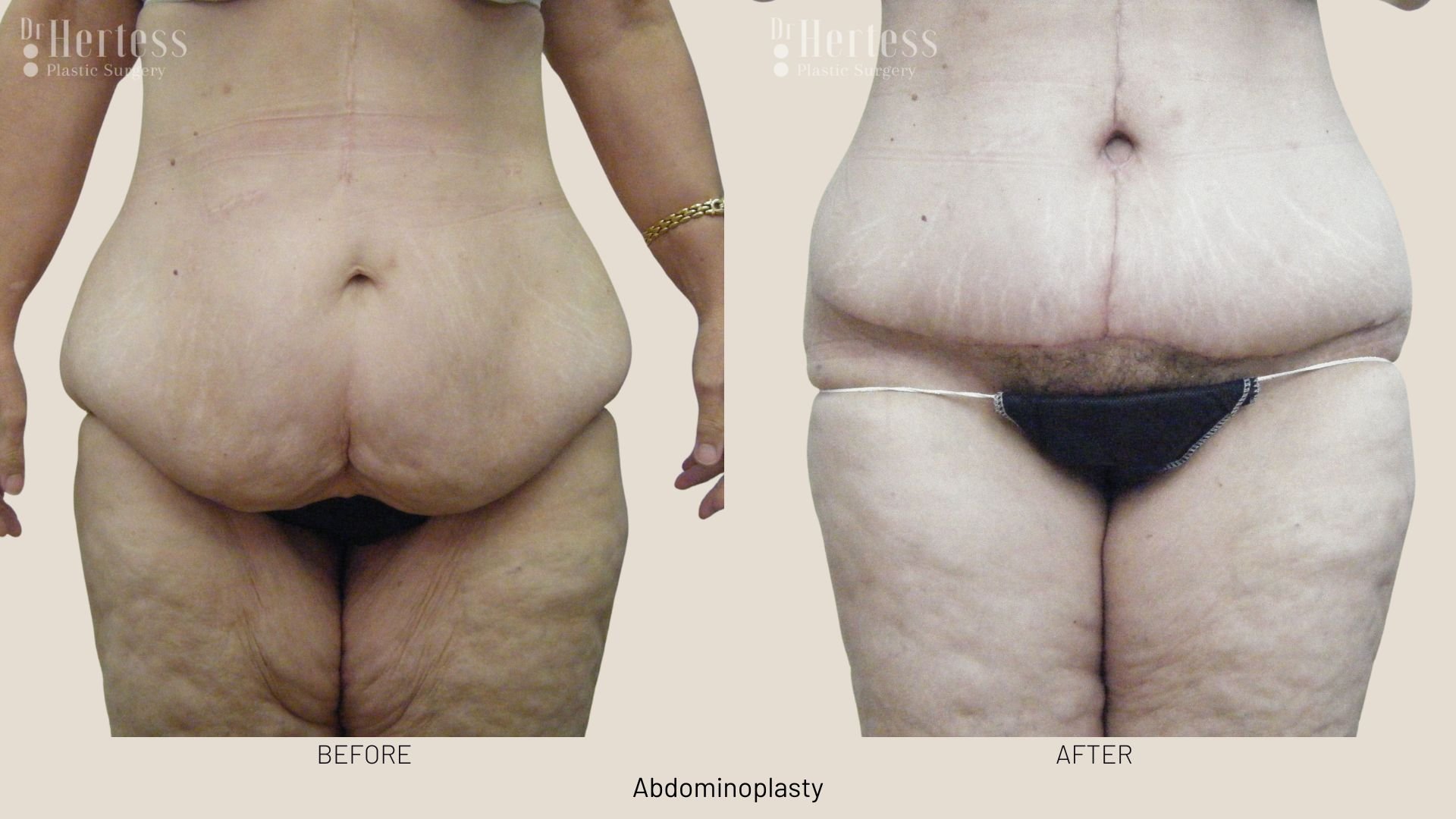 tummy tuck surgery before and after