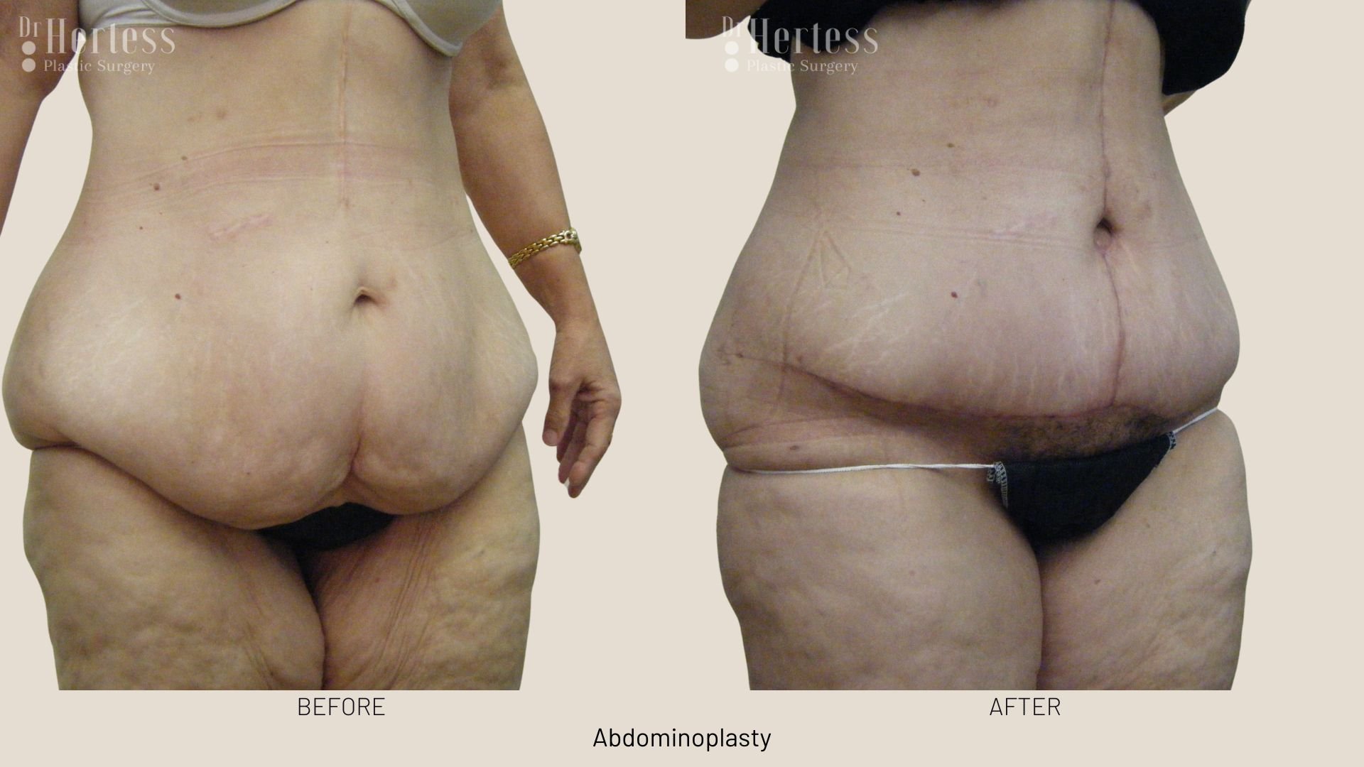 abdominoplasty before after