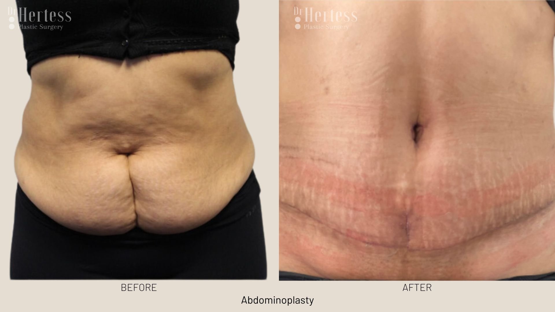 abdominoplasty before after