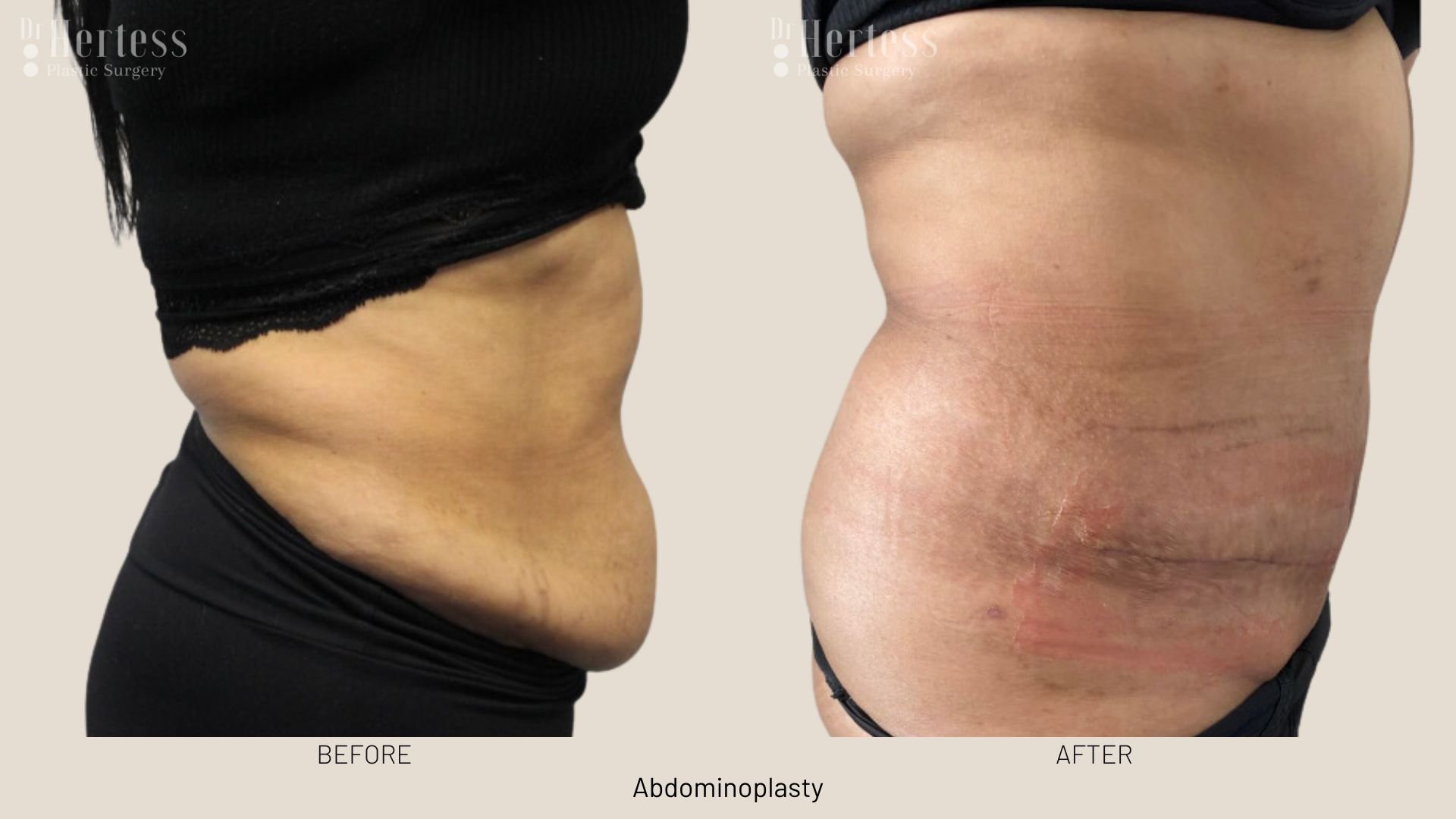 abdominoplasty before after