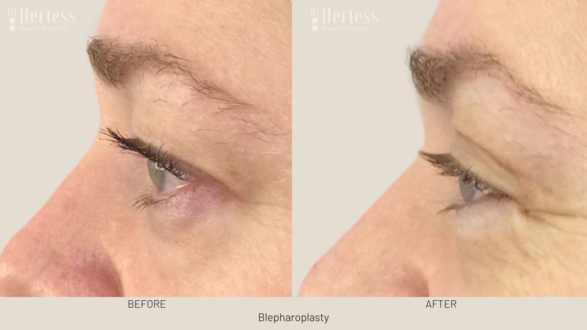 blephs before after