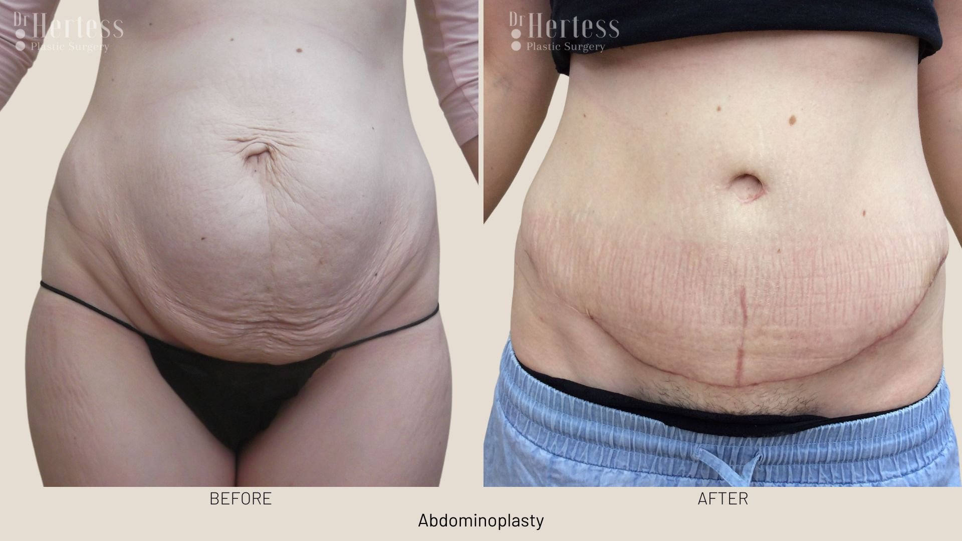 abdominoplasty before after