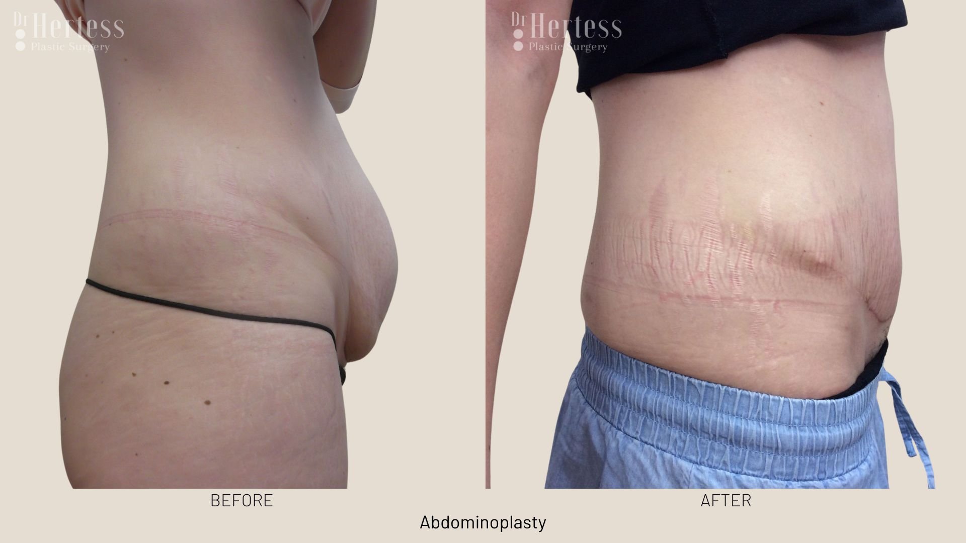 abdominoplasty before after