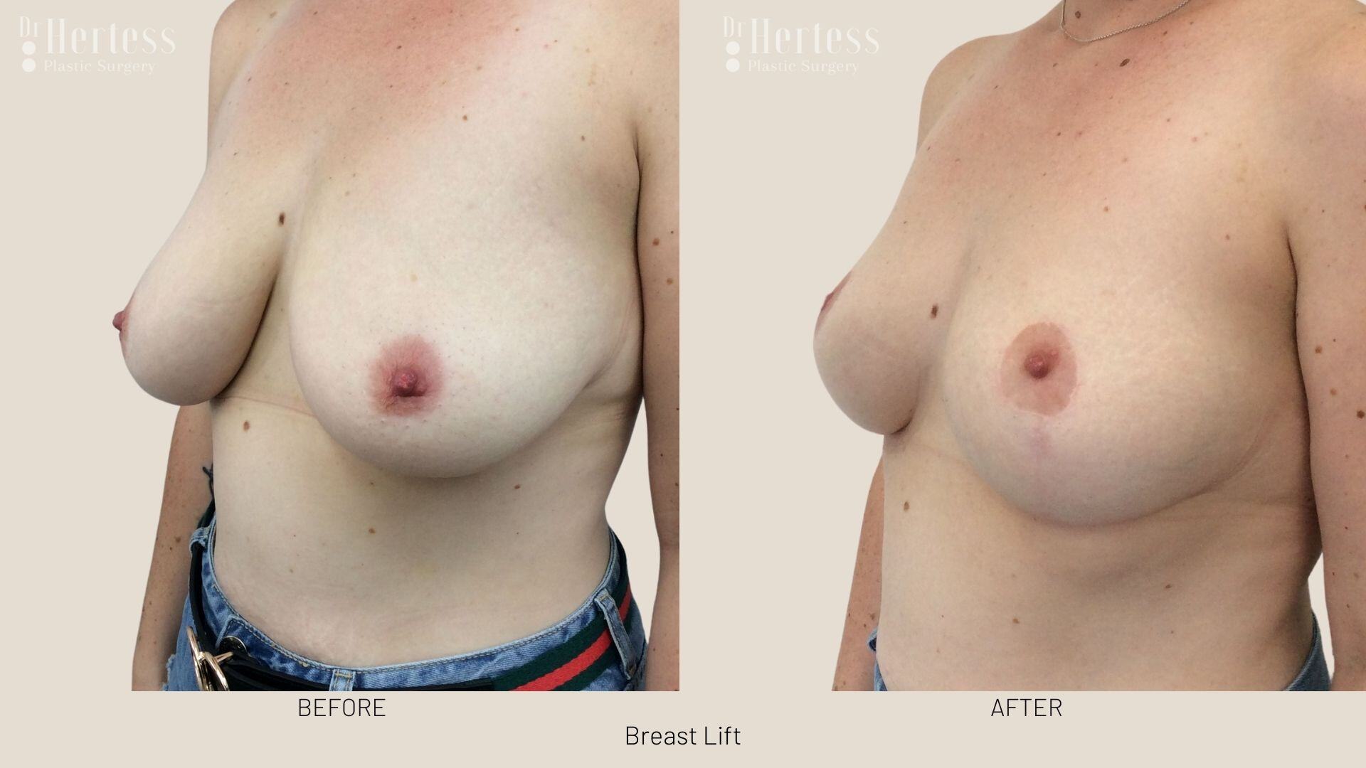 breast lift photos