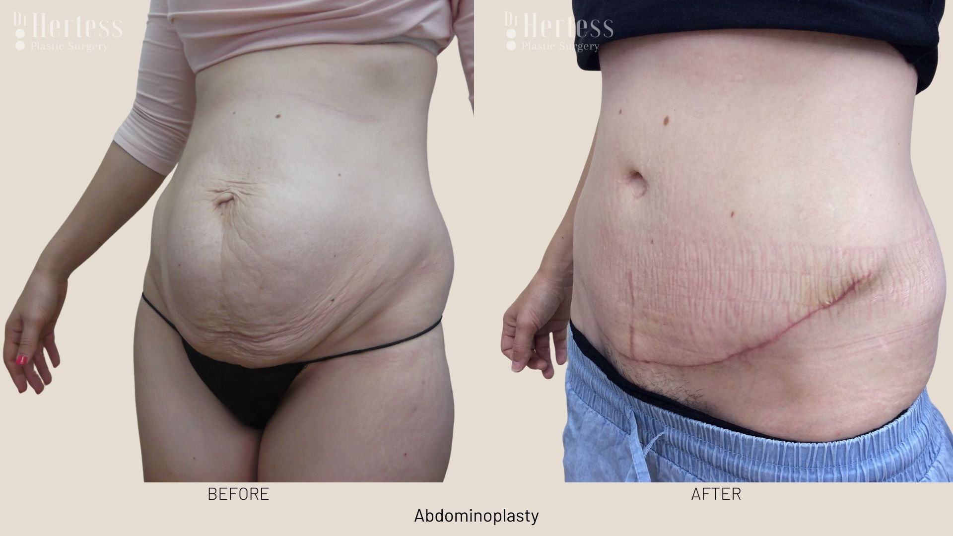 abdominoplasty before after