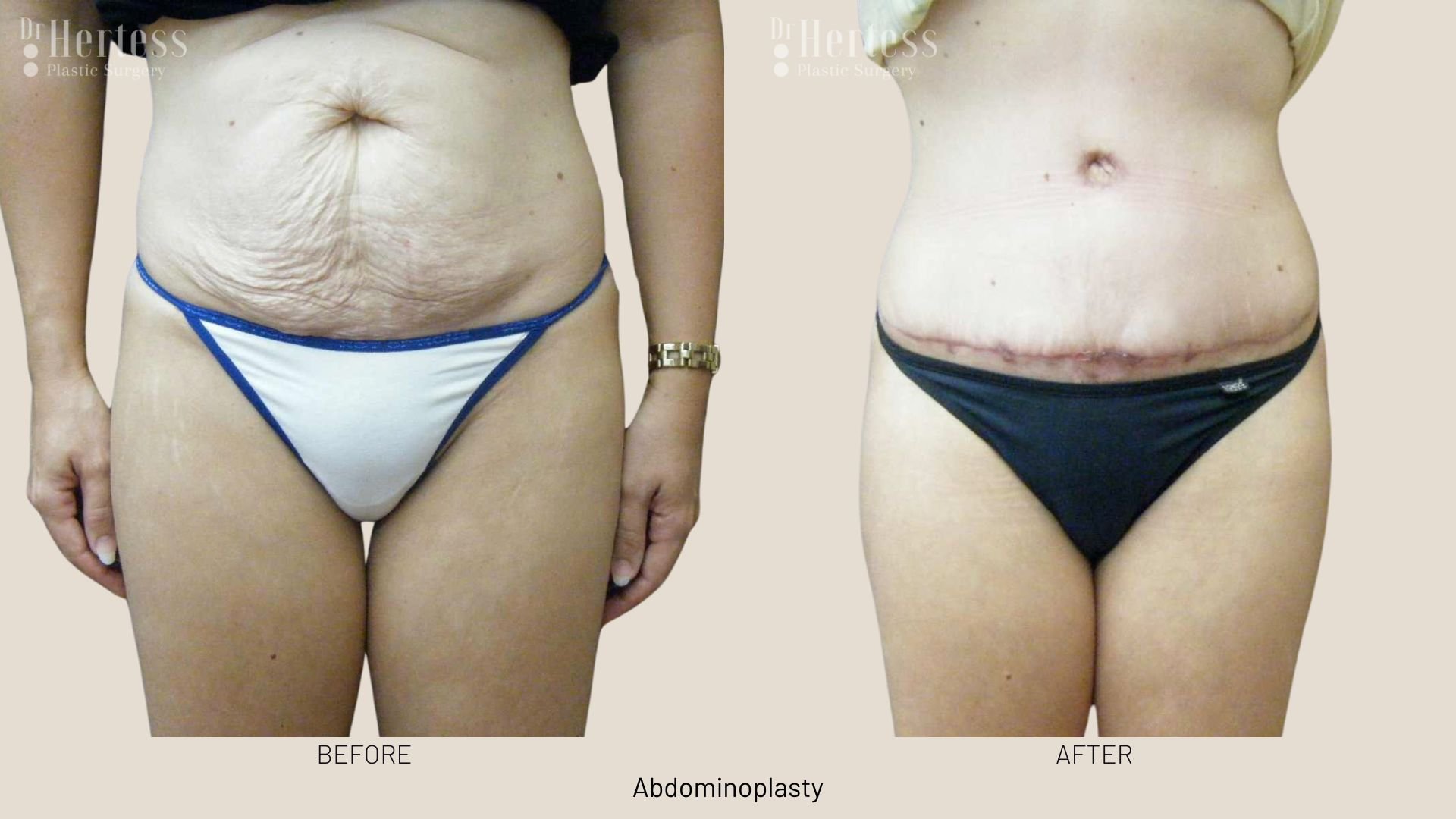 abdominoplasty before after